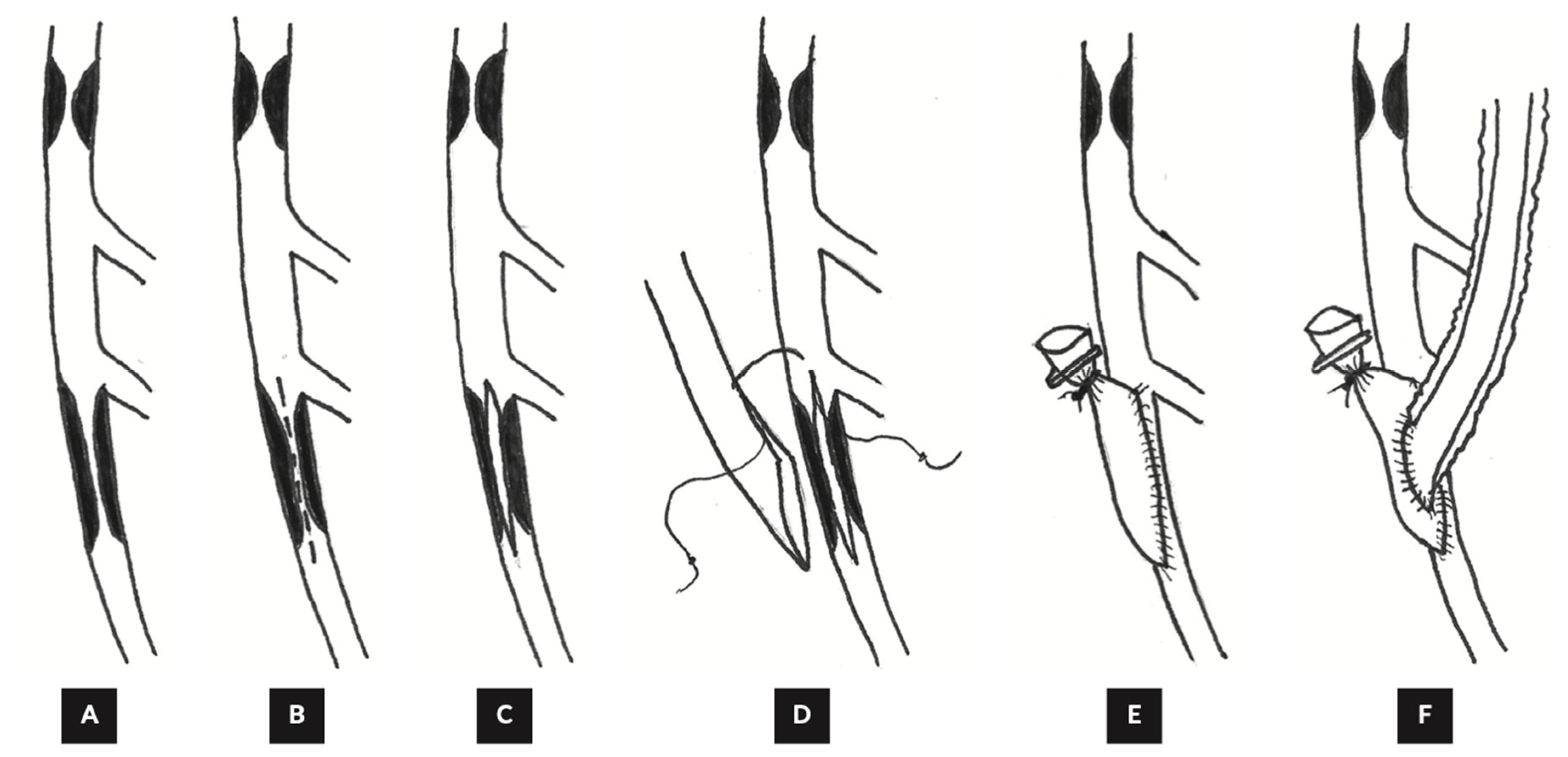 Complex Coronary Artery Bypass Grafting: Intraoperative Challenges and ...