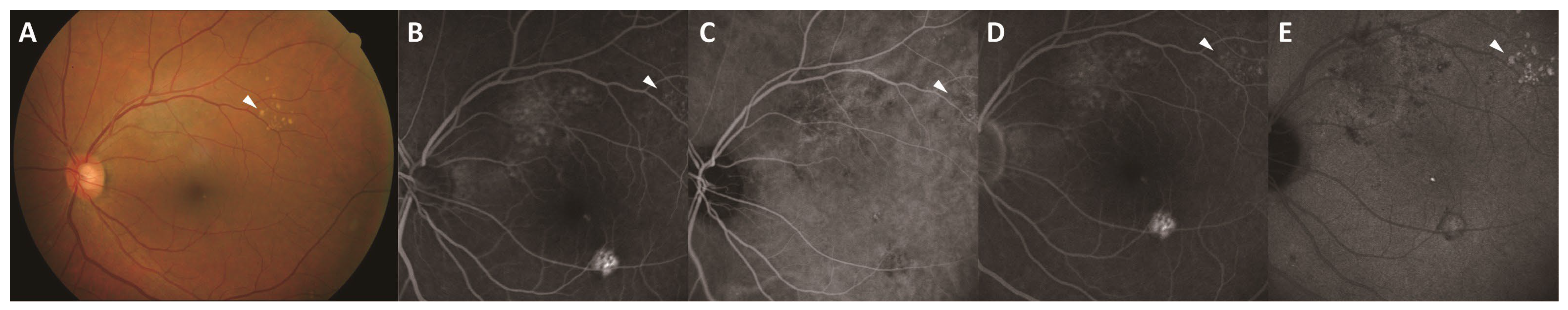 Five-Year Changes in Pachydrusen with Late-Phase Hyperfluorescence on ...