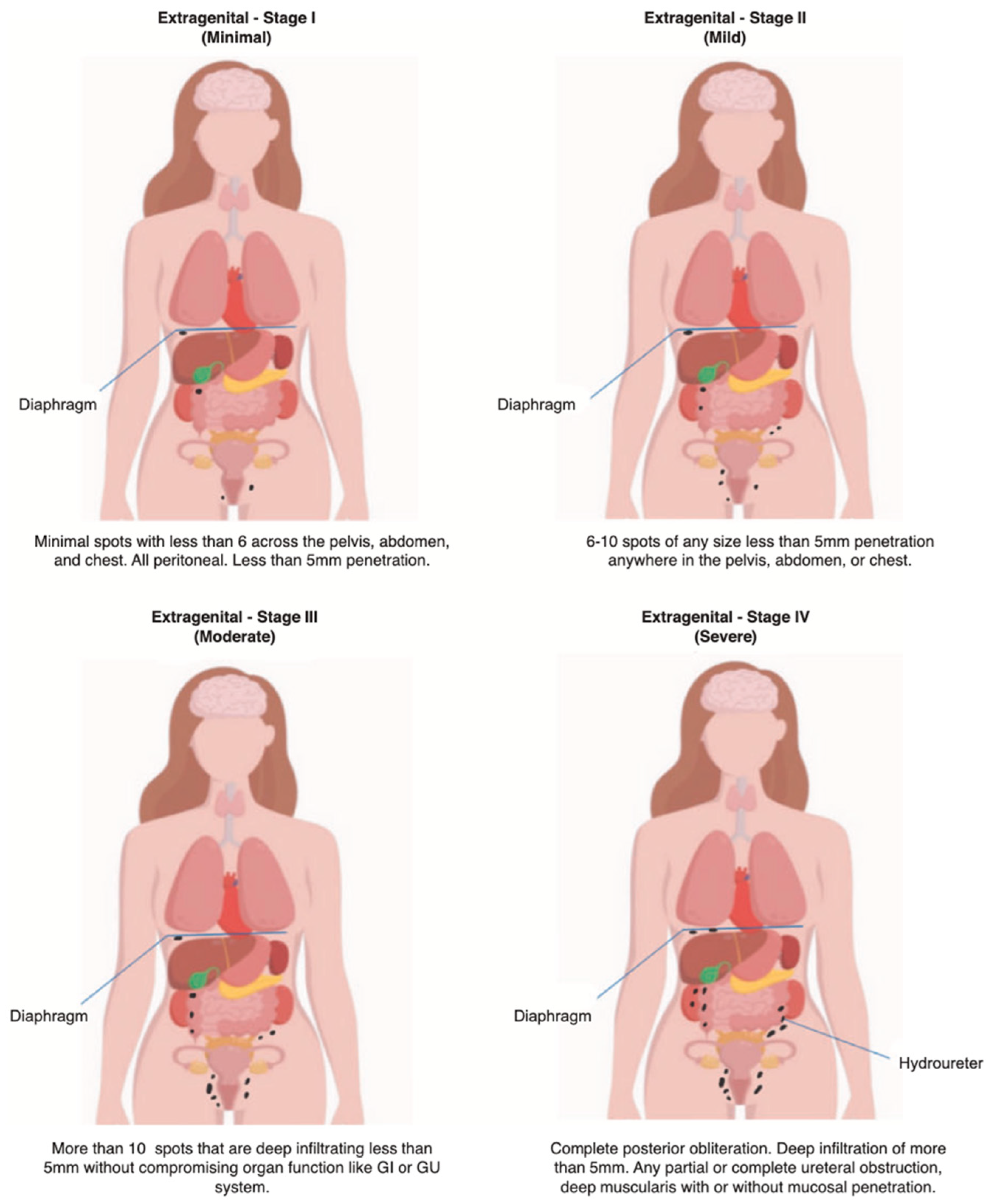 The AGCES Classification System for Endometriosis: Integrating ...