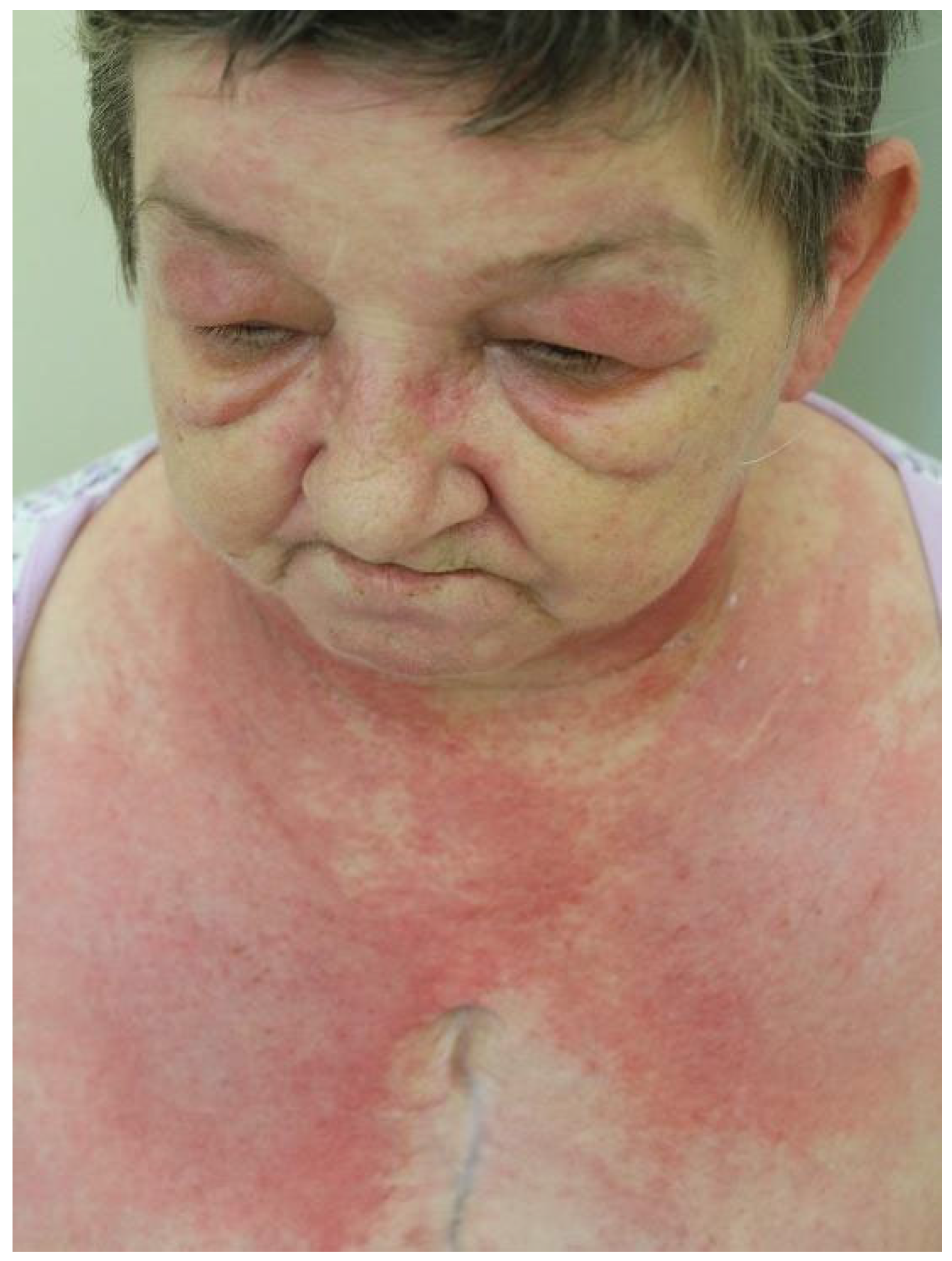 The Spectrum of Cutaneous Manifestations in Dermatomyositis: A ...