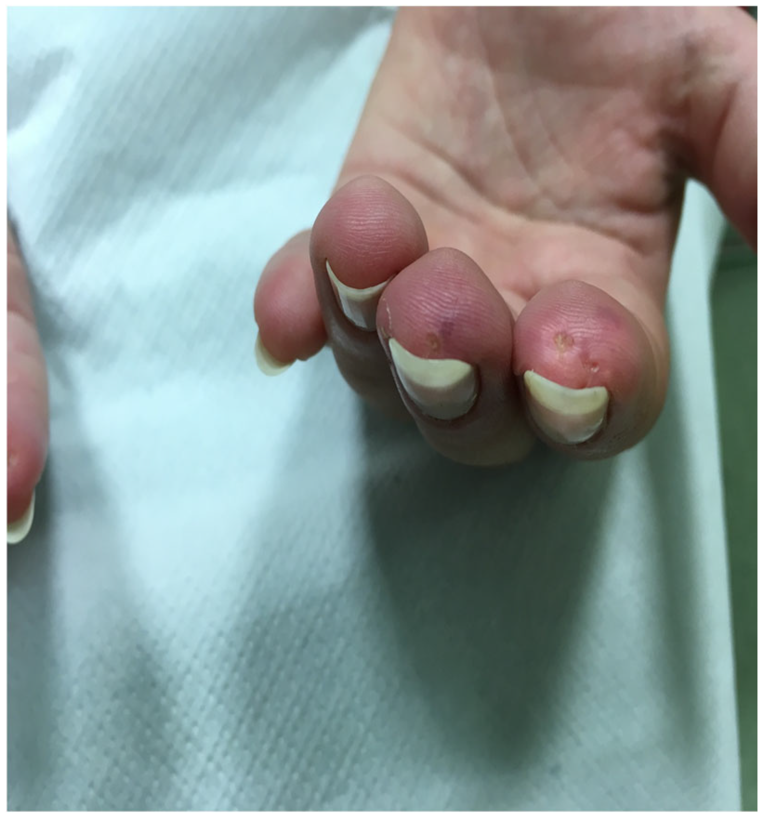 The Spectrum of Cutaneous Manifestations in Dermatomyositis: A ...
