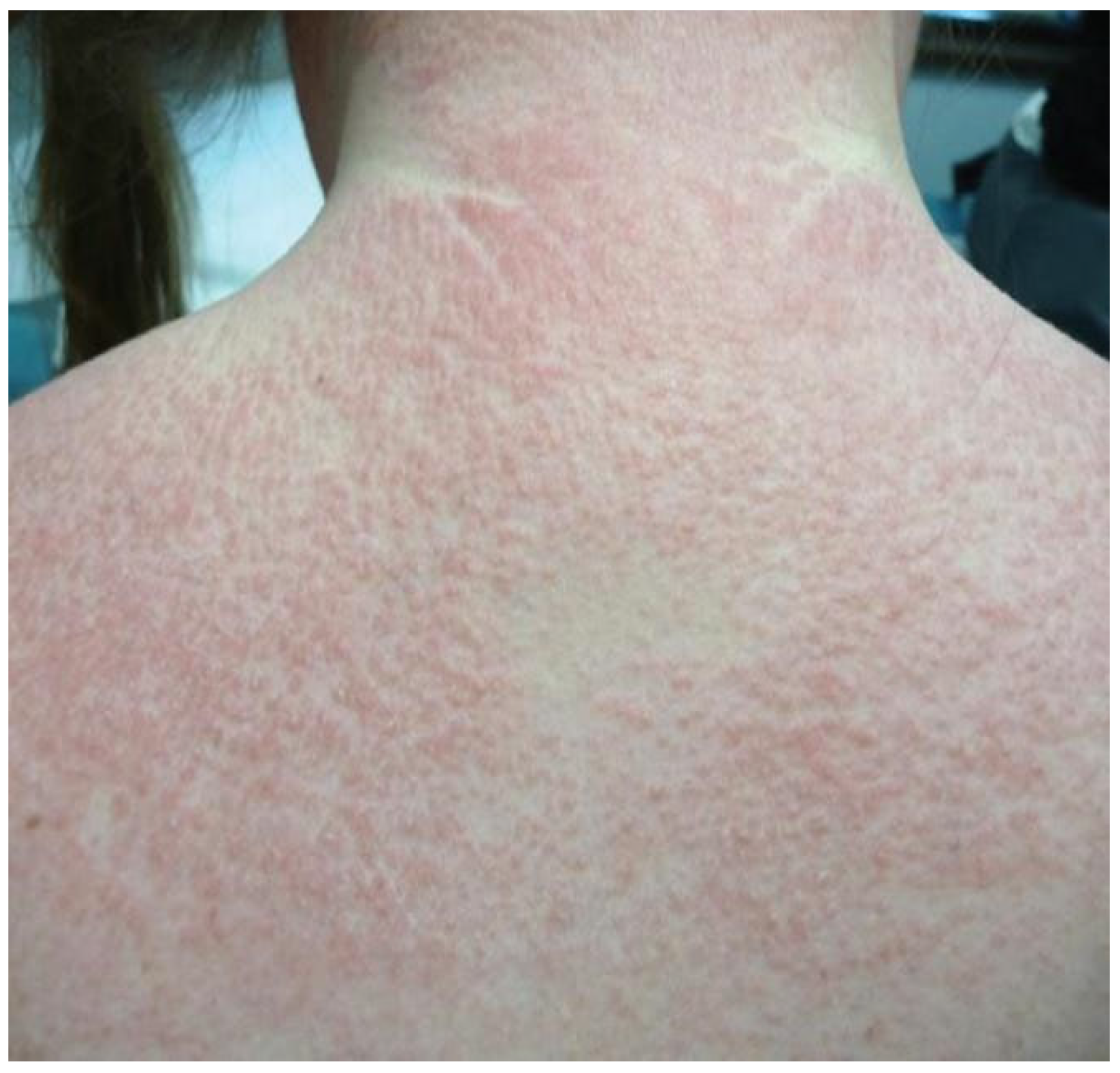 The Spectrum of Cutaneous Manifestations in Dermatomyositis: A ...