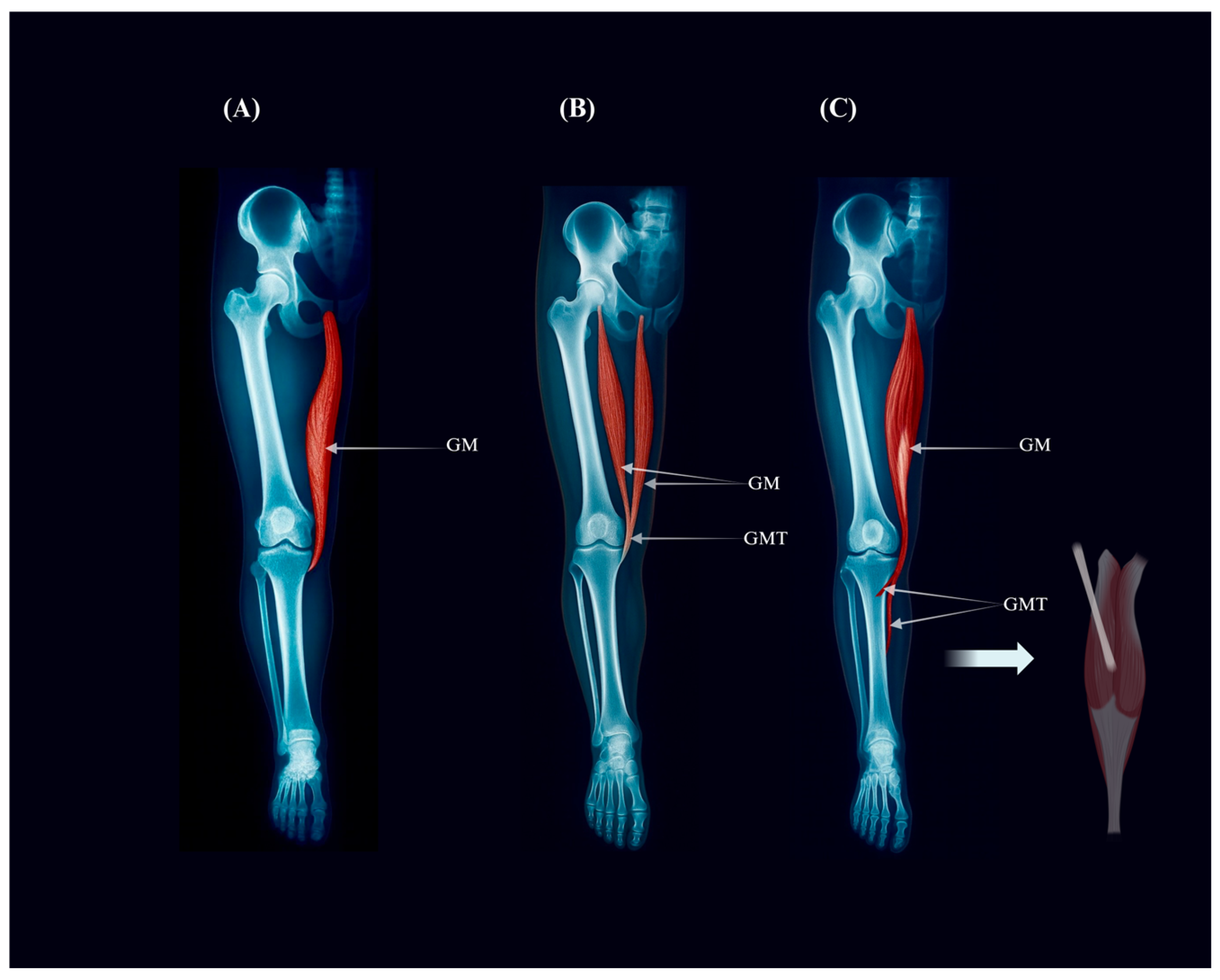 The Gracilis Muscle Reappraised: An Integrative Synthesis of Anatomy ...