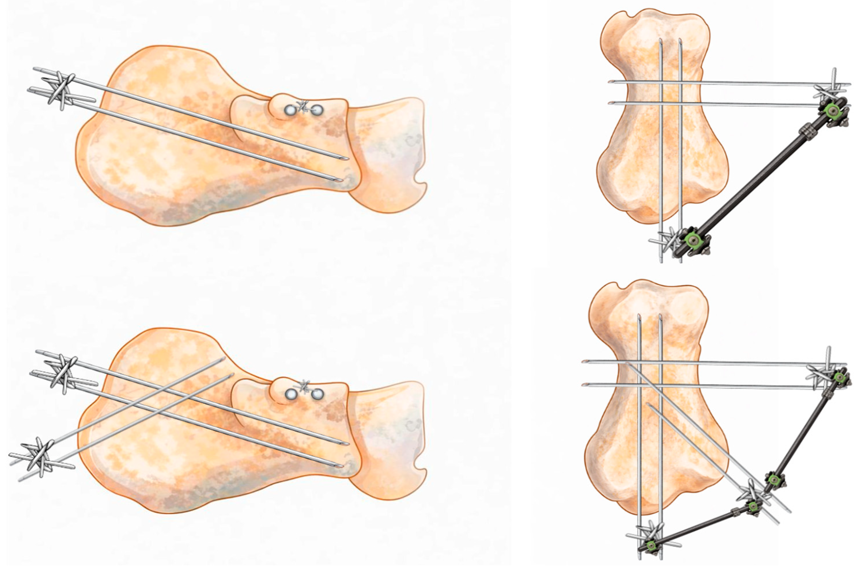 A Modified Design External Fixator System for Calcaneal Fractures ...