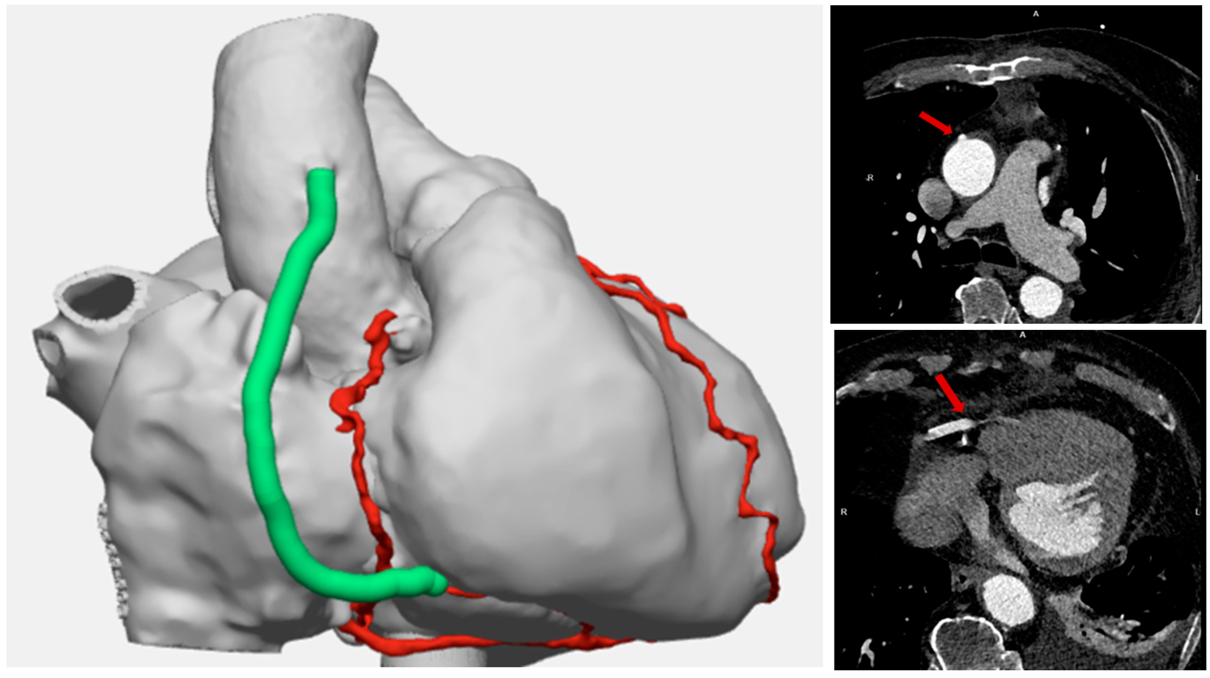 First European Clinical Implant of an Off-the-Shelf Bioengineered Blood ...