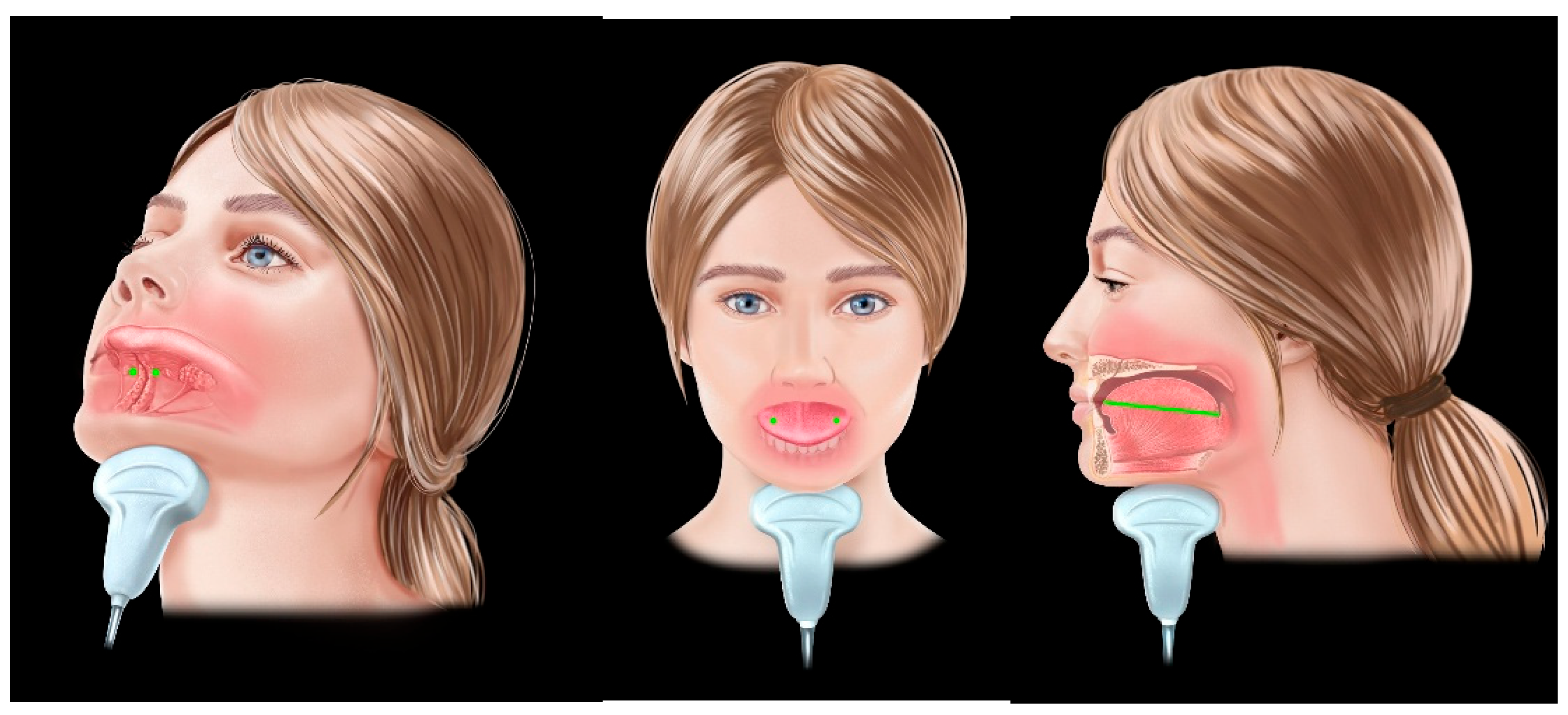 Ultrasonographic Assessment of Upper Airway Structures in Adult ...