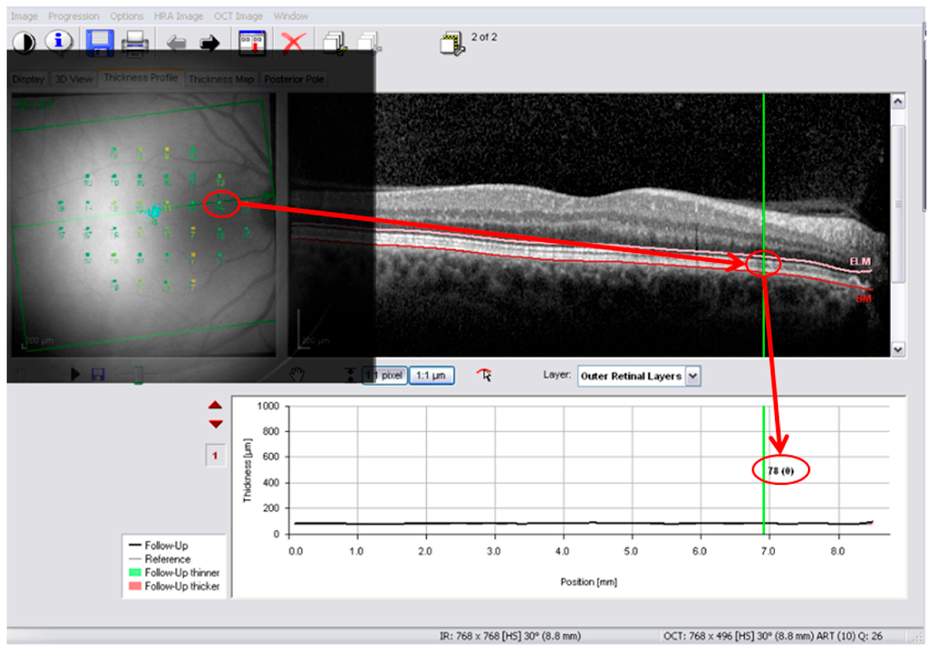 Point-to-Point Macular Structure–Function Relationships in Healthy and ...
