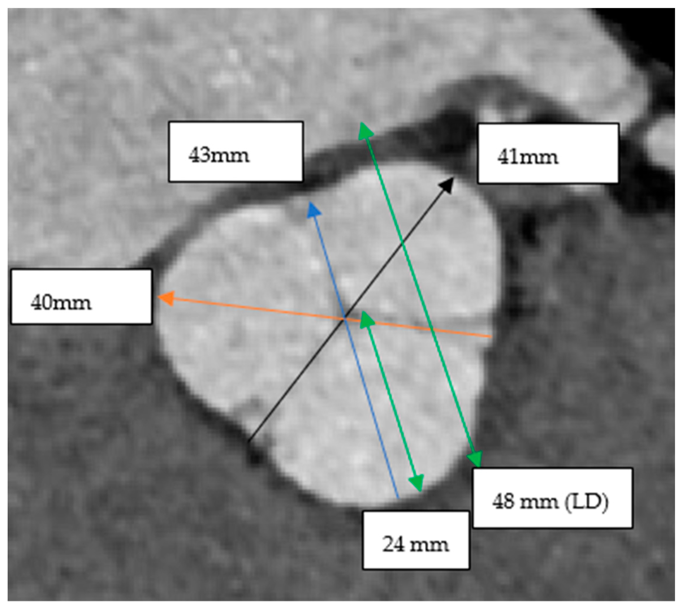 Root Diam Strategies for Aortic Root Measurement in Patients Undergoing ...