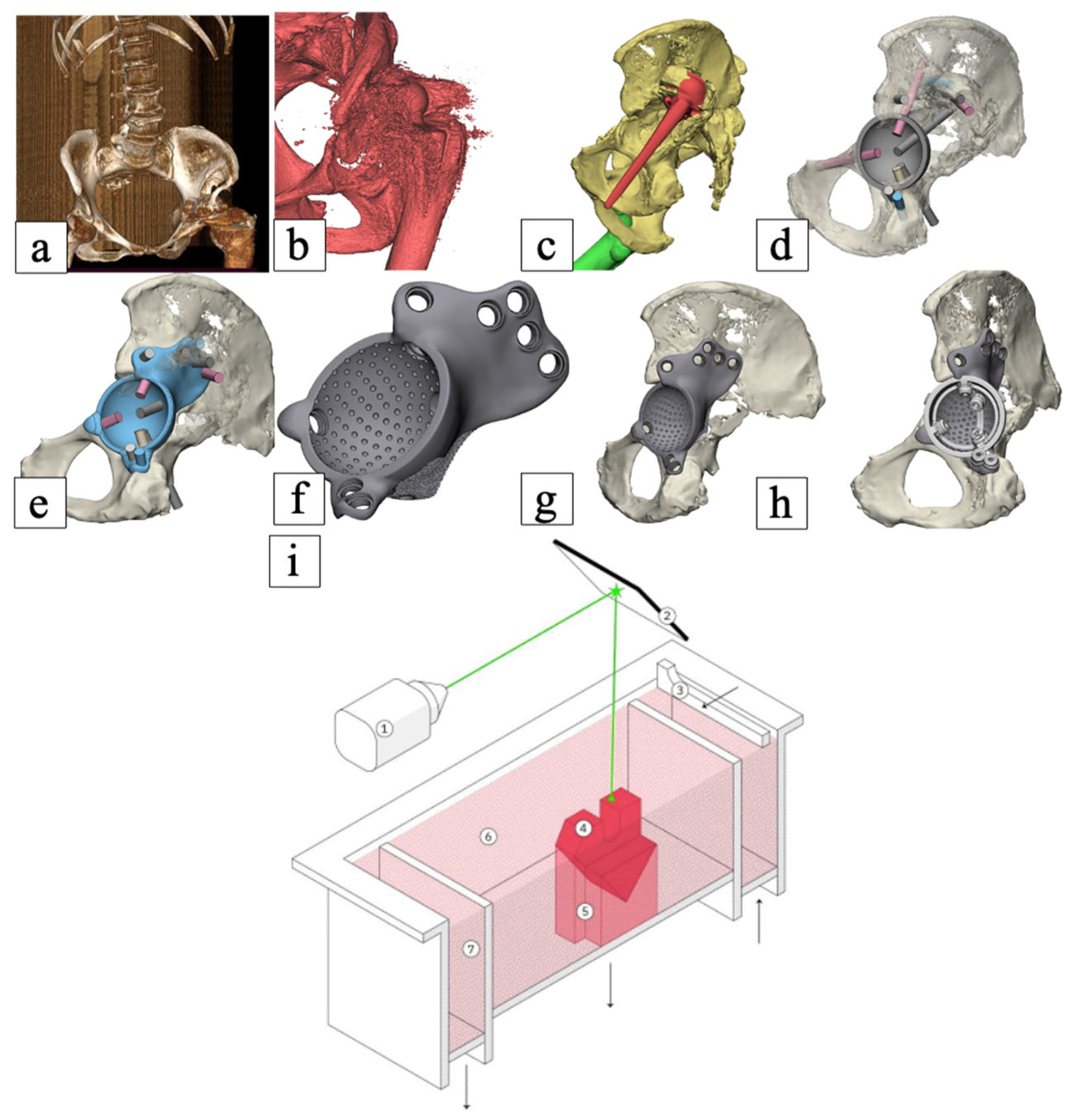 Use of Custom-Designed Additive-Manufactured Acetabular Components for ...