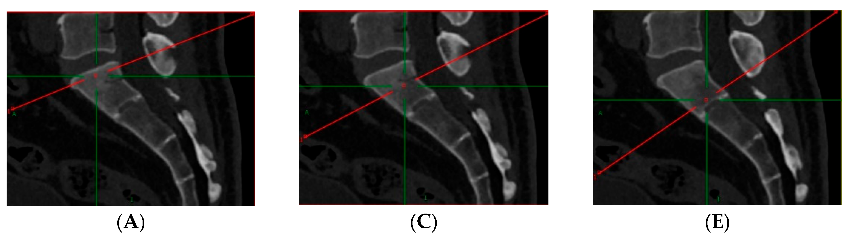 Prediction of Osteoporosis at the Sacrum Using Opportunistic CT of the ...