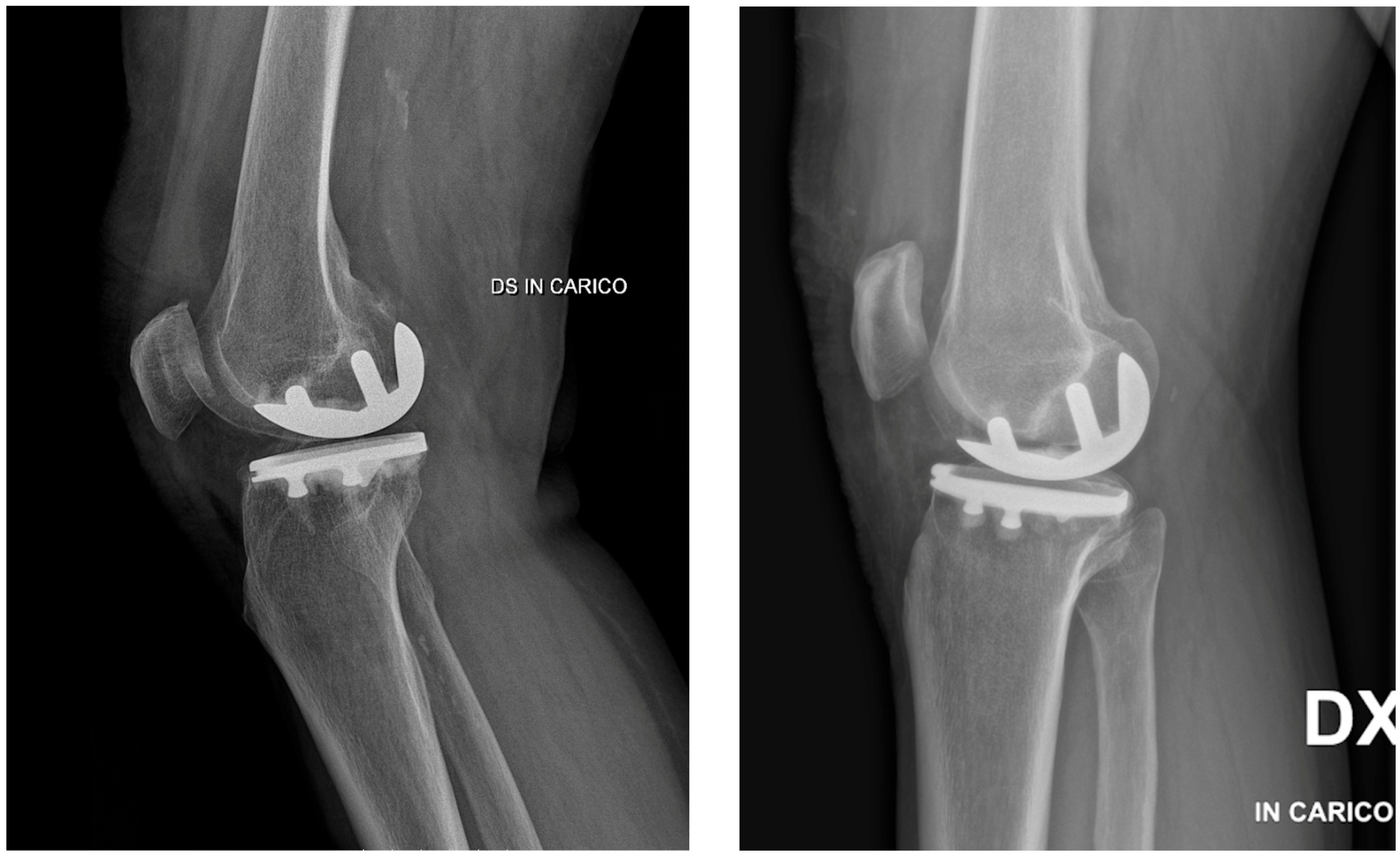 Zimmer Rosa Tibial Array Accuracy of ROSA® Partial Knee System in Tibial Alignment During Medial ...