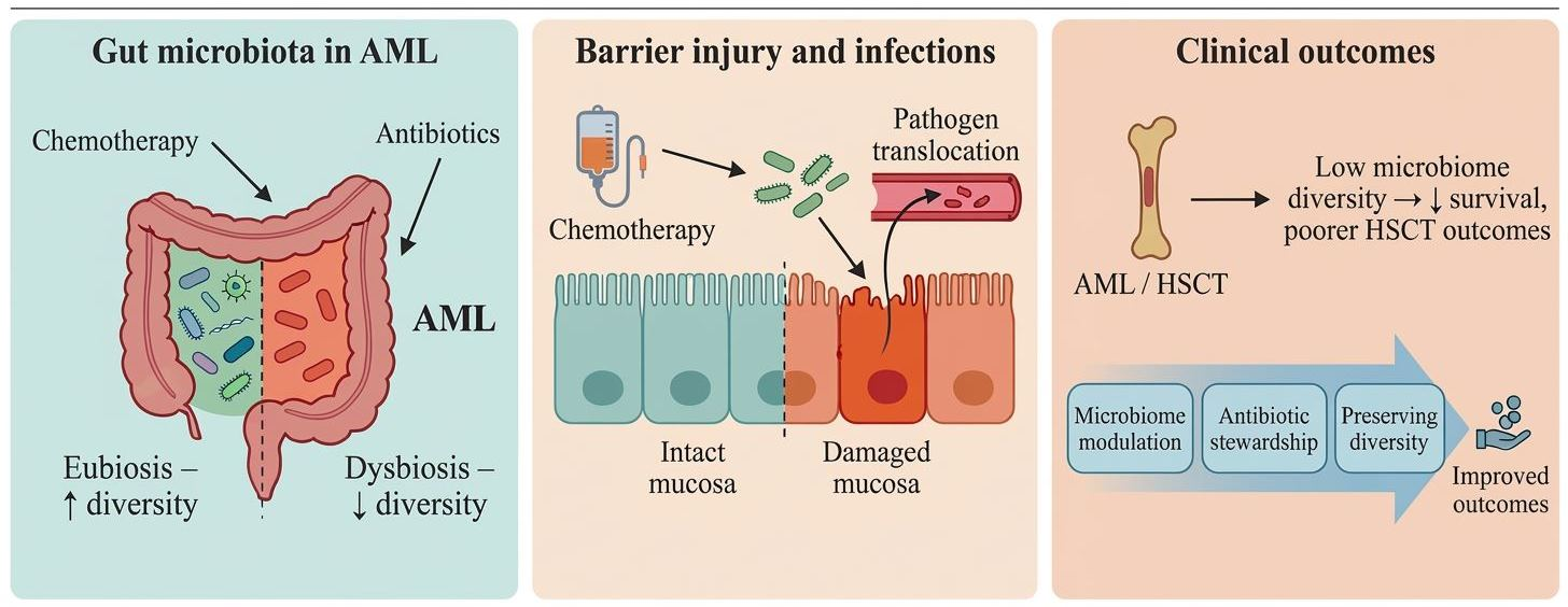 The Role of Gut Microbiota in Acute Myeloid Leukemia