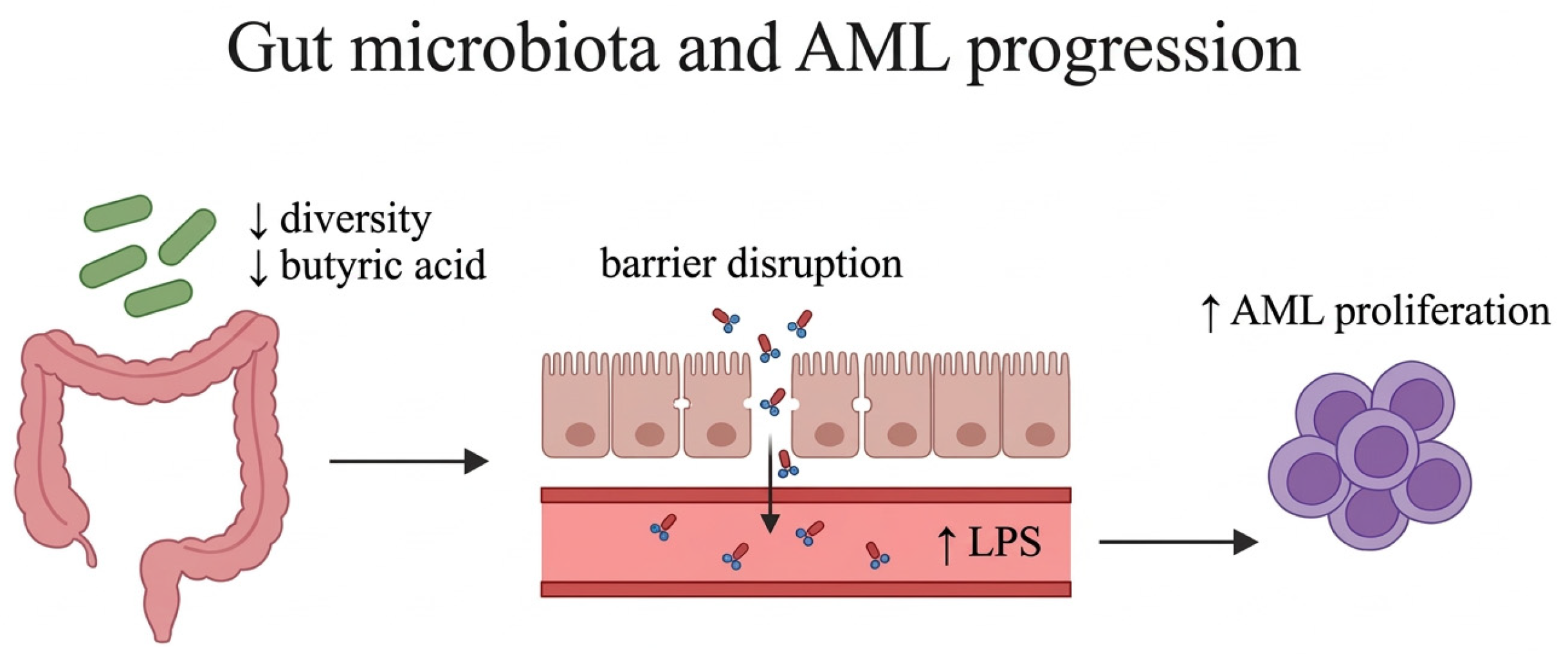 The Role of Gut Microbiota in Acute Myeloid Leukemia