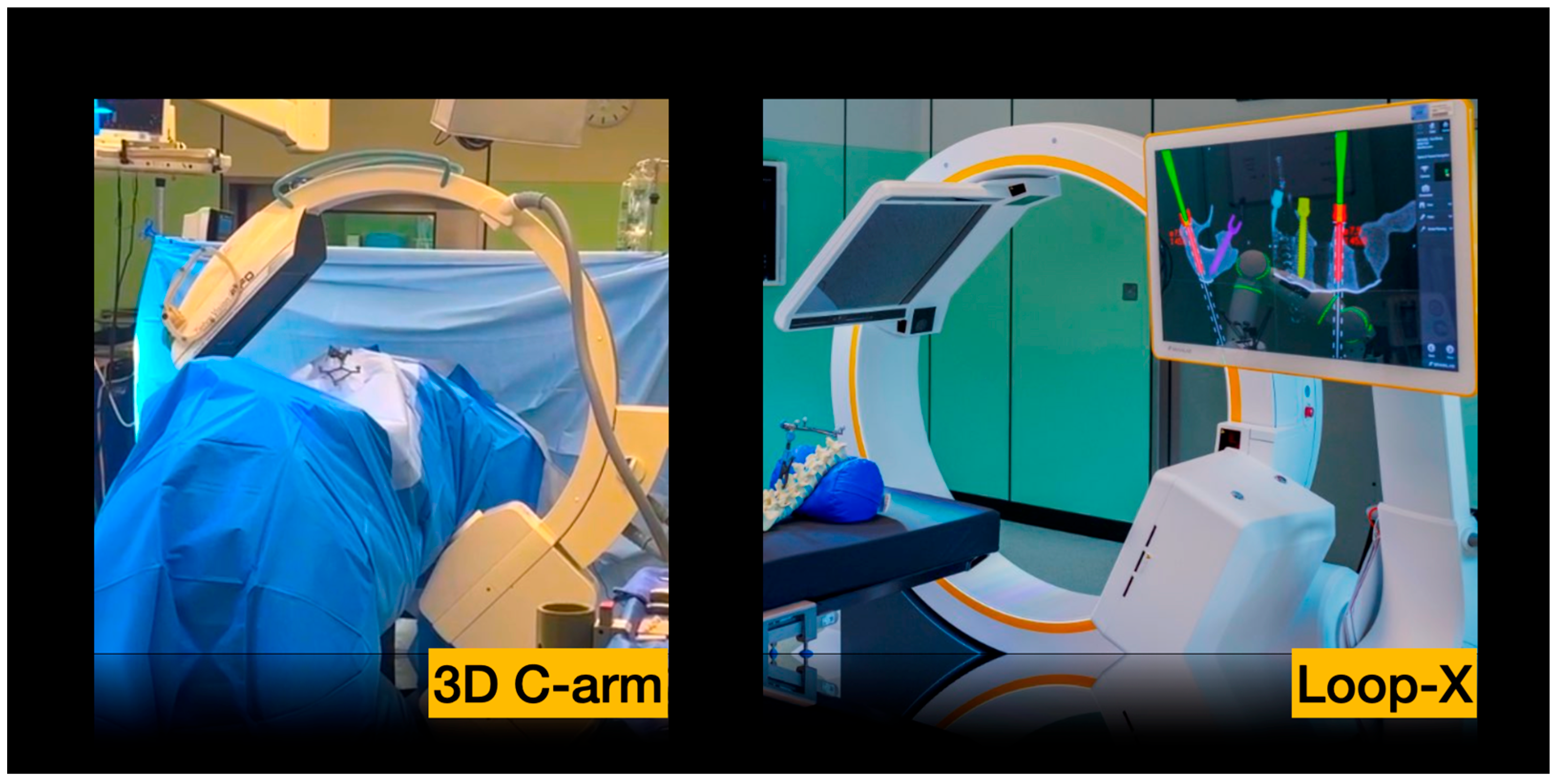 Implementation of Intraoperative Cone-Beam CT (Loop-X) in an ...