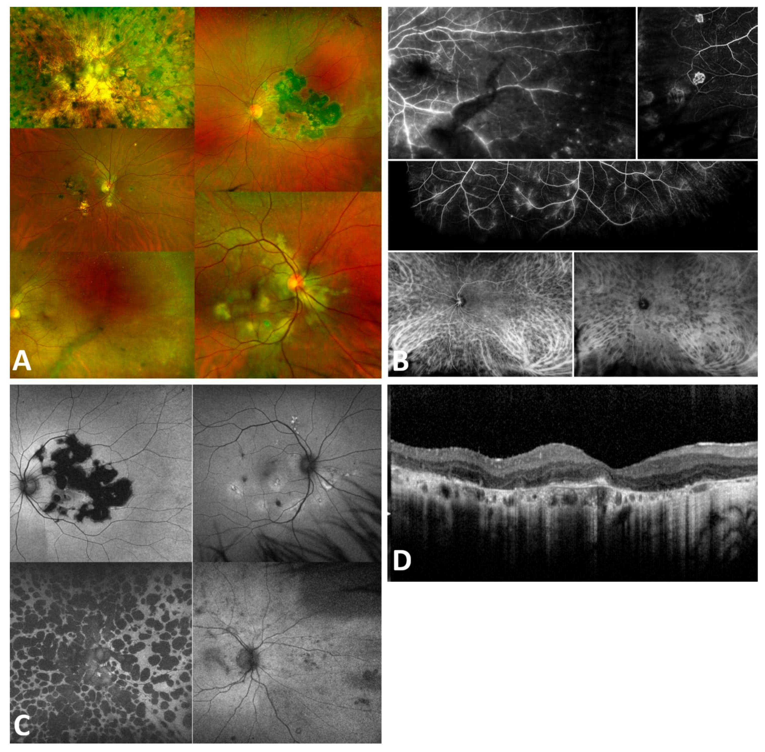 Advanced Multimodal Imaging in Granulomatous Uveitis: From Differential ...