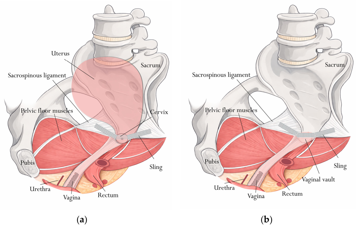 Bilateral Sacrospinous Colposuspension with Sling for Advanced Pelvic ...