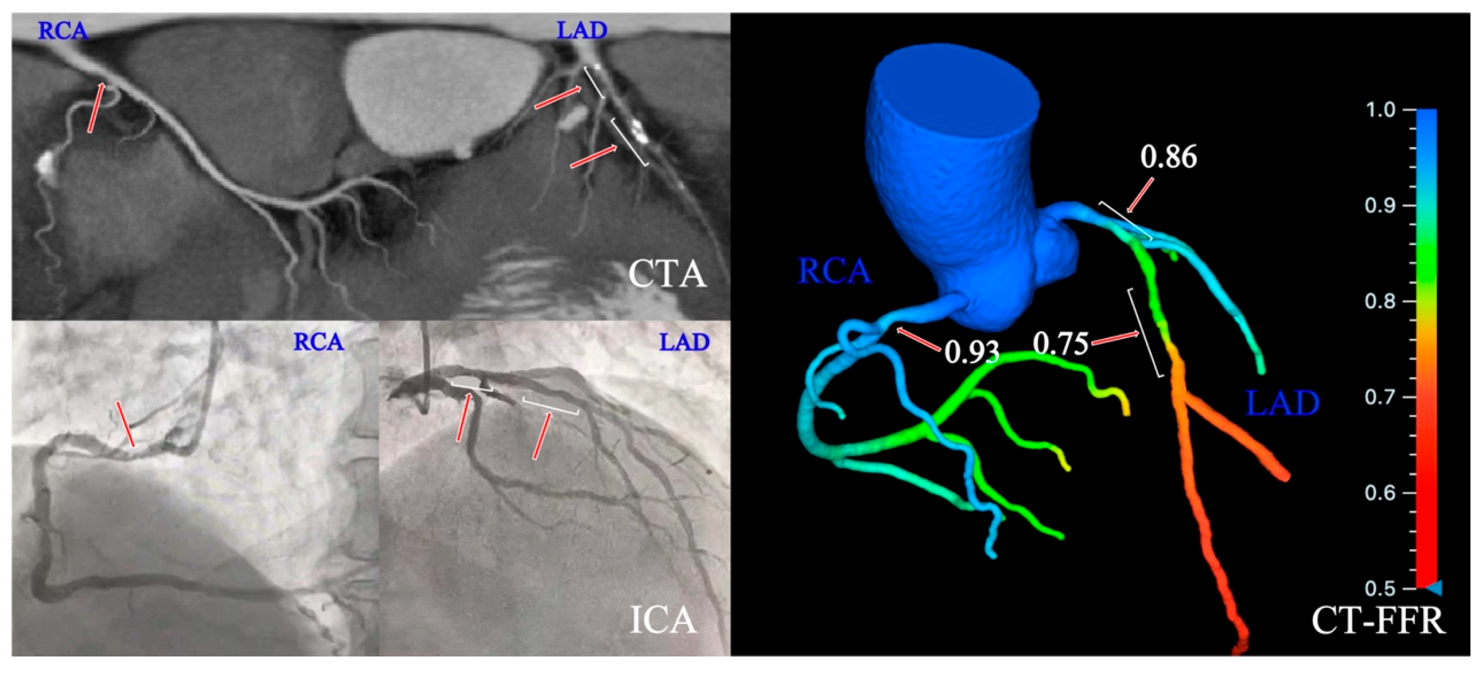 Prognostic Implication of a CT-FFR-Based Functional SYNTAX Score in ...