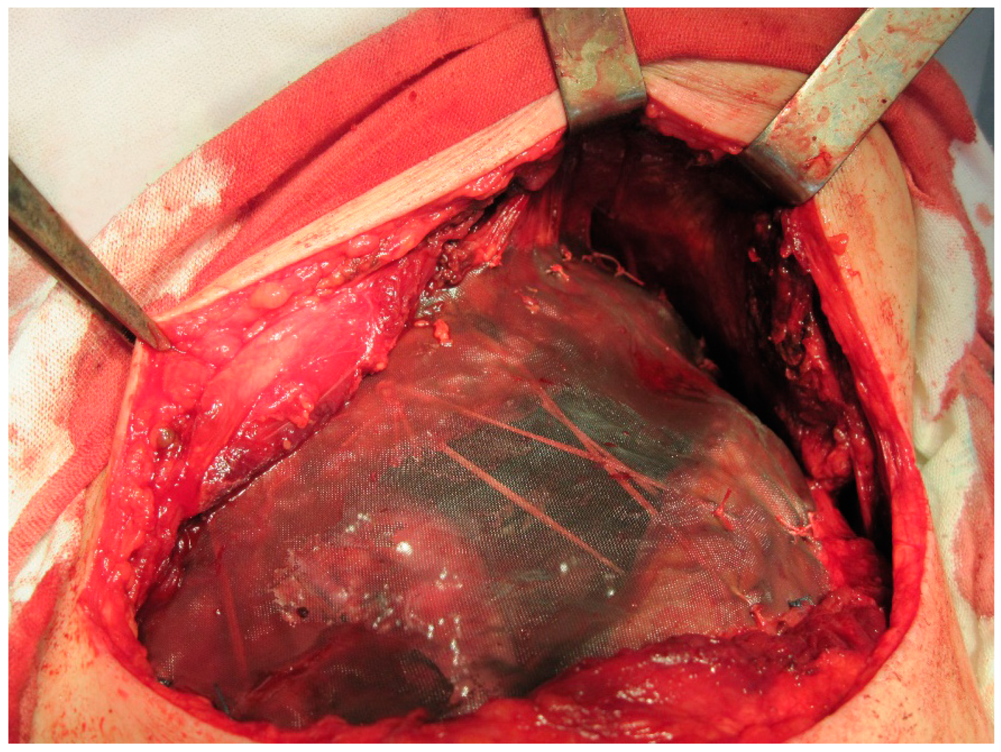 A) Chest wall defect after complete resection of the piece, with