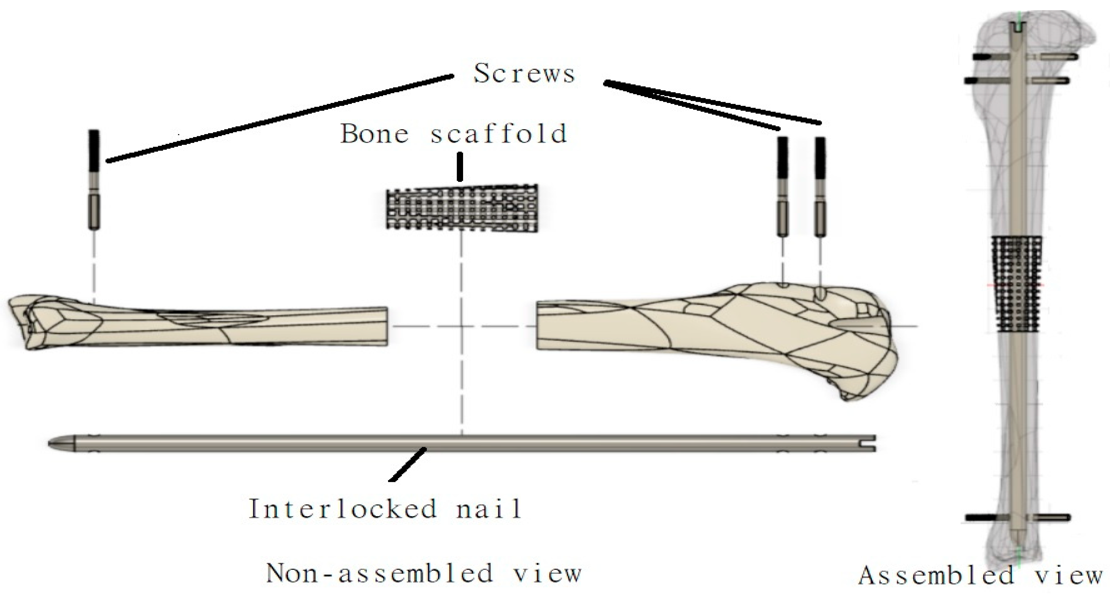 Interlocking Nail Instruments Set features & images • Vast Ortho