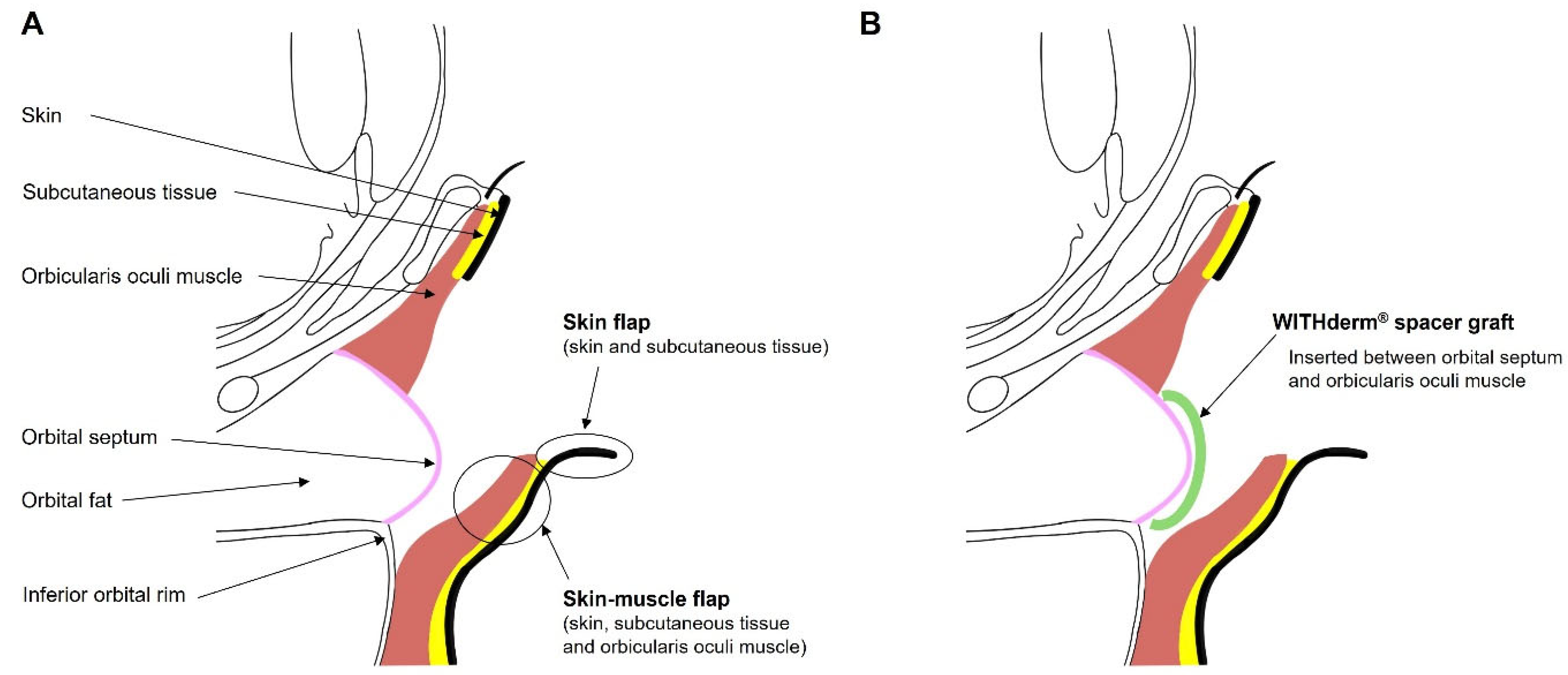 Subciliary Approach Incision Acellular Dermal Matrix (WITHderm®) Spacer Grafts for the Prevention of ...