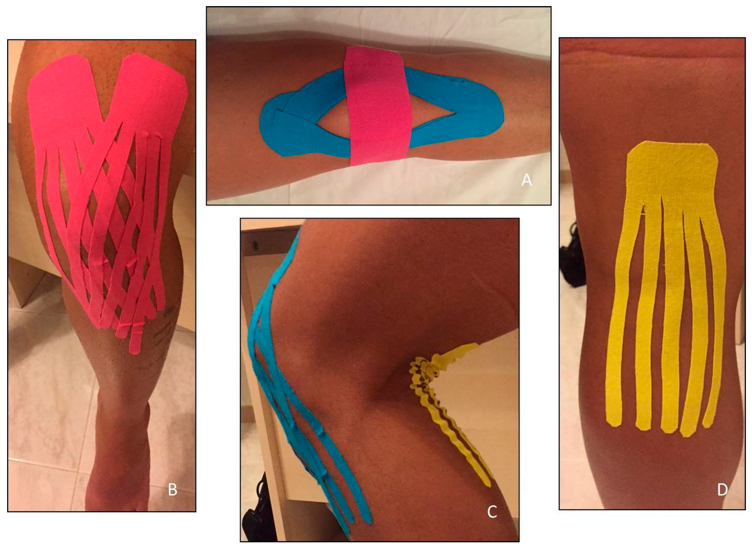 Kinesiology Tape for Arthritis: Does It Help Treat Pain and Stiffness?