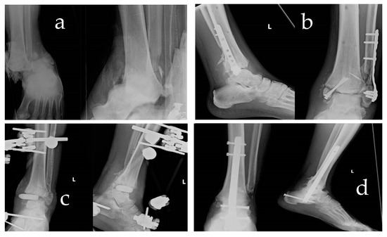Frontiers | Outcome of Pantalar Fusion With Femoral Head Allograft in  Avascular Necrosis of Talus