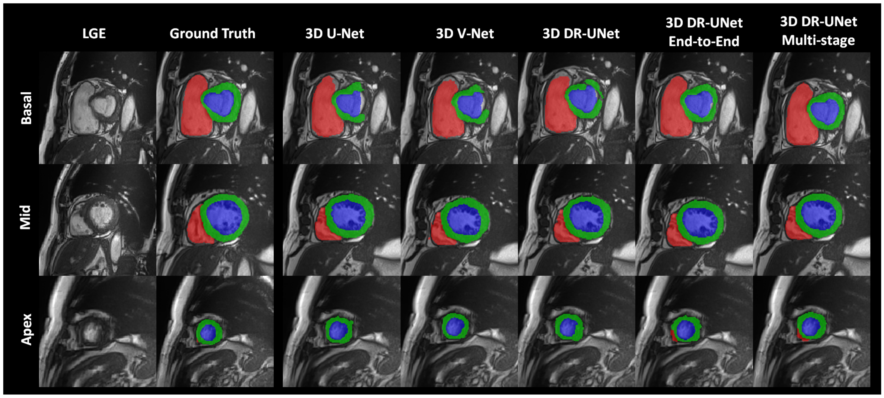 Fully Automated 3D Cardiac MRI Localisation And Segmentation Using Deep Fully Automated 3D Cardiac MRI Localisation And Segmentation Using Deep