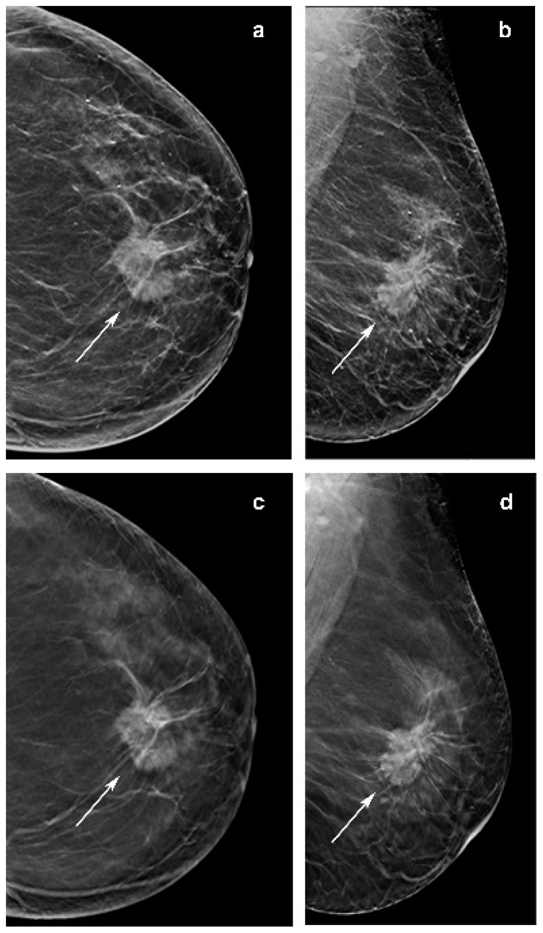 Increased asymmetry with larger breast size following the oncoplastic  parallelogram mastopexy lumpectomy for cancer - Chen - 2021 - The Breast  Journal - Wiley Online Library