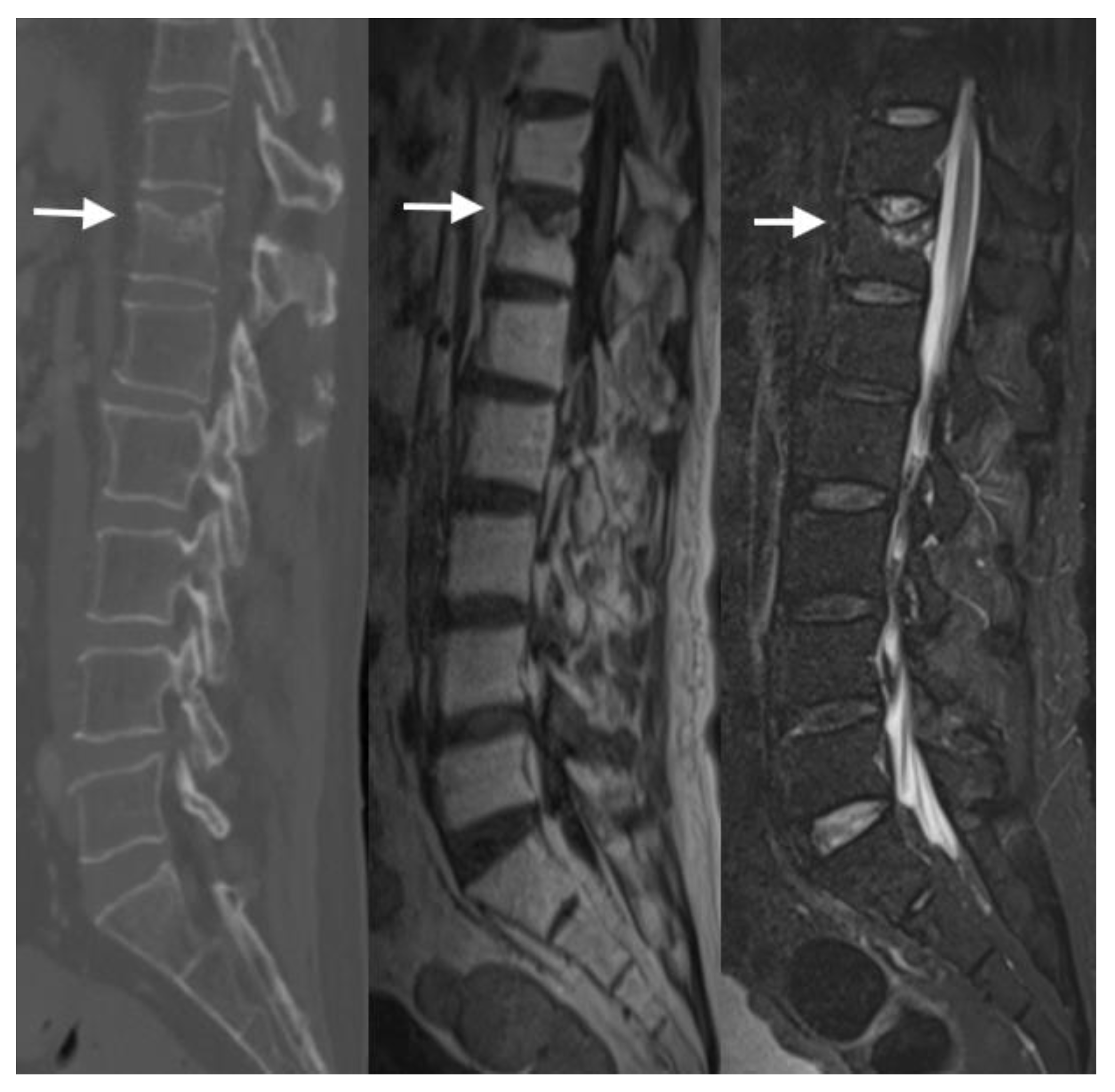 Radiological Diagnosis and Advances in Imaging of Vertebral Compression ...