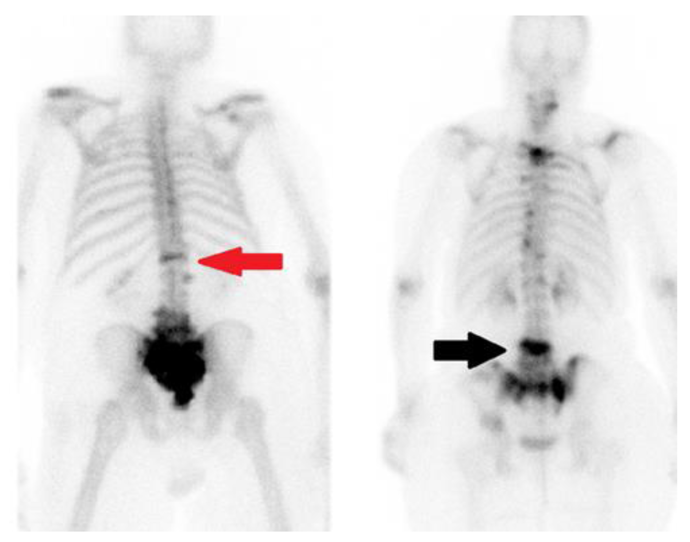 Radiological Diagnosis And Advances In Imaging Of Vertebral Compression Fractures