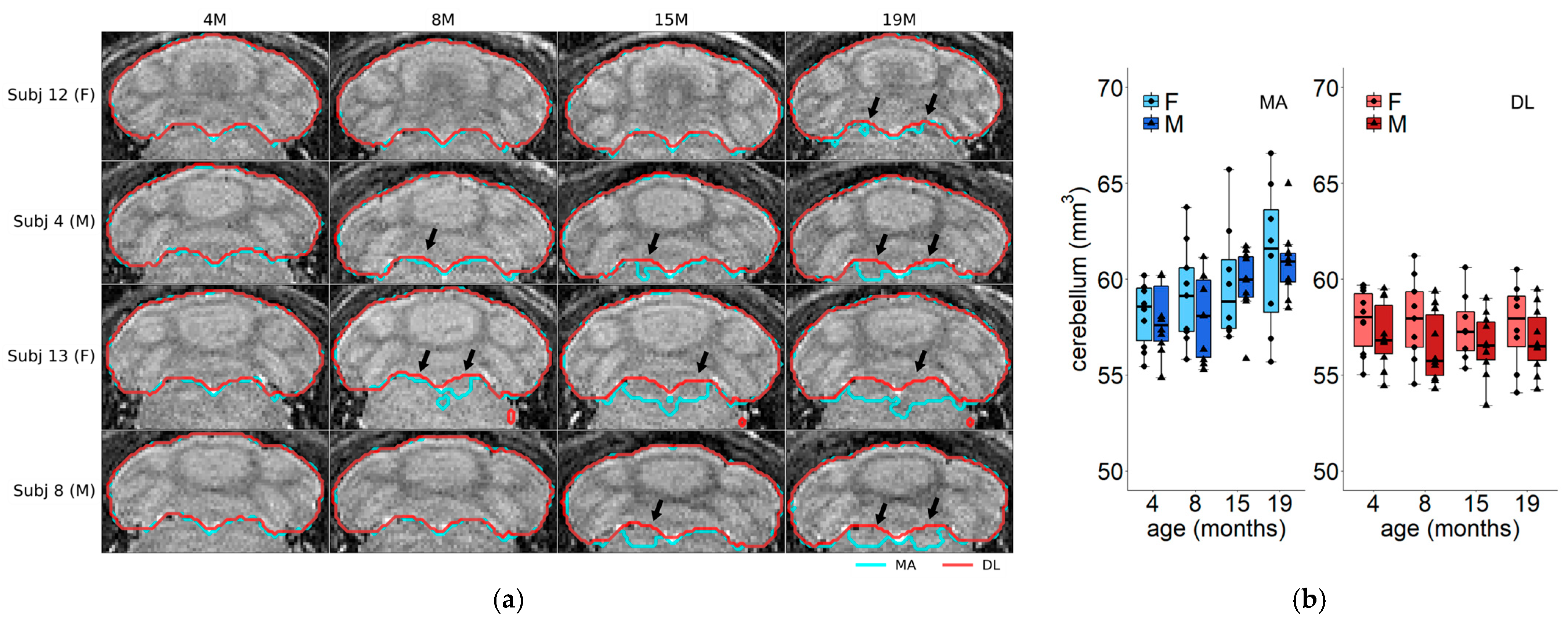 Deep Learning and Atlas-Based MRI Segmentation Enable Longitudinal ...