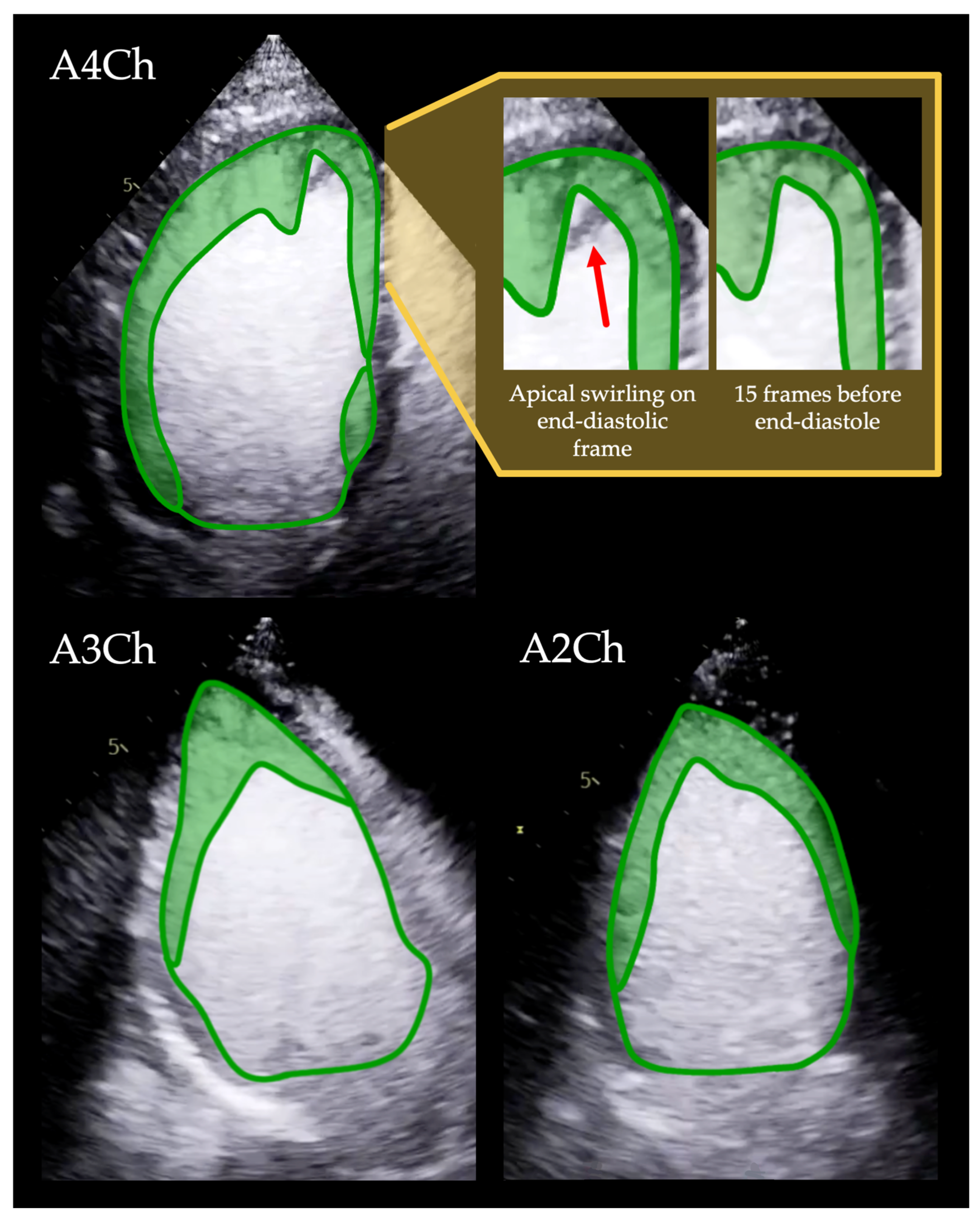Trabeculation Touchdown Novel, Contrast Echocardiography-Based Trabeculation Quantification ...