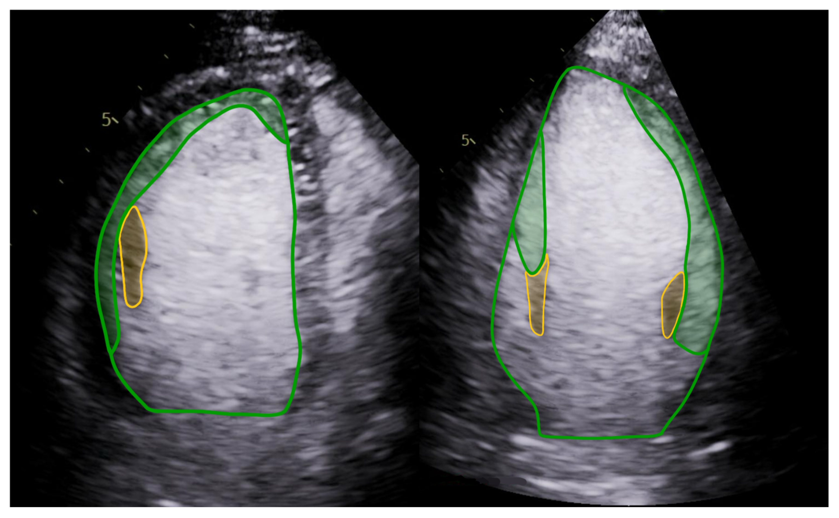 Trabeculation Touchdown Novel, Contrast Echocardiography-Based Trabeculation Quantification ...