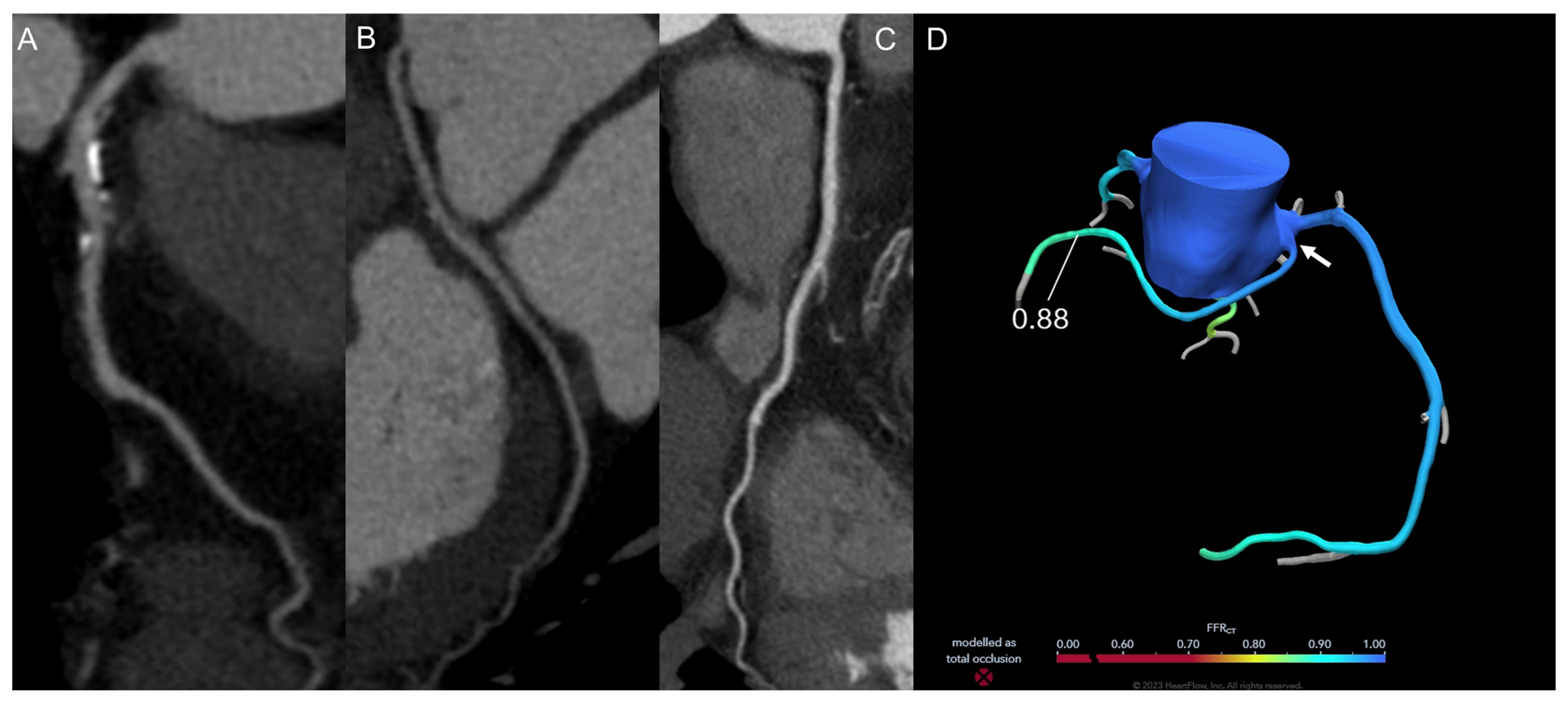 FFR-CT: Technical Advances and Implementation in Clinical Practice