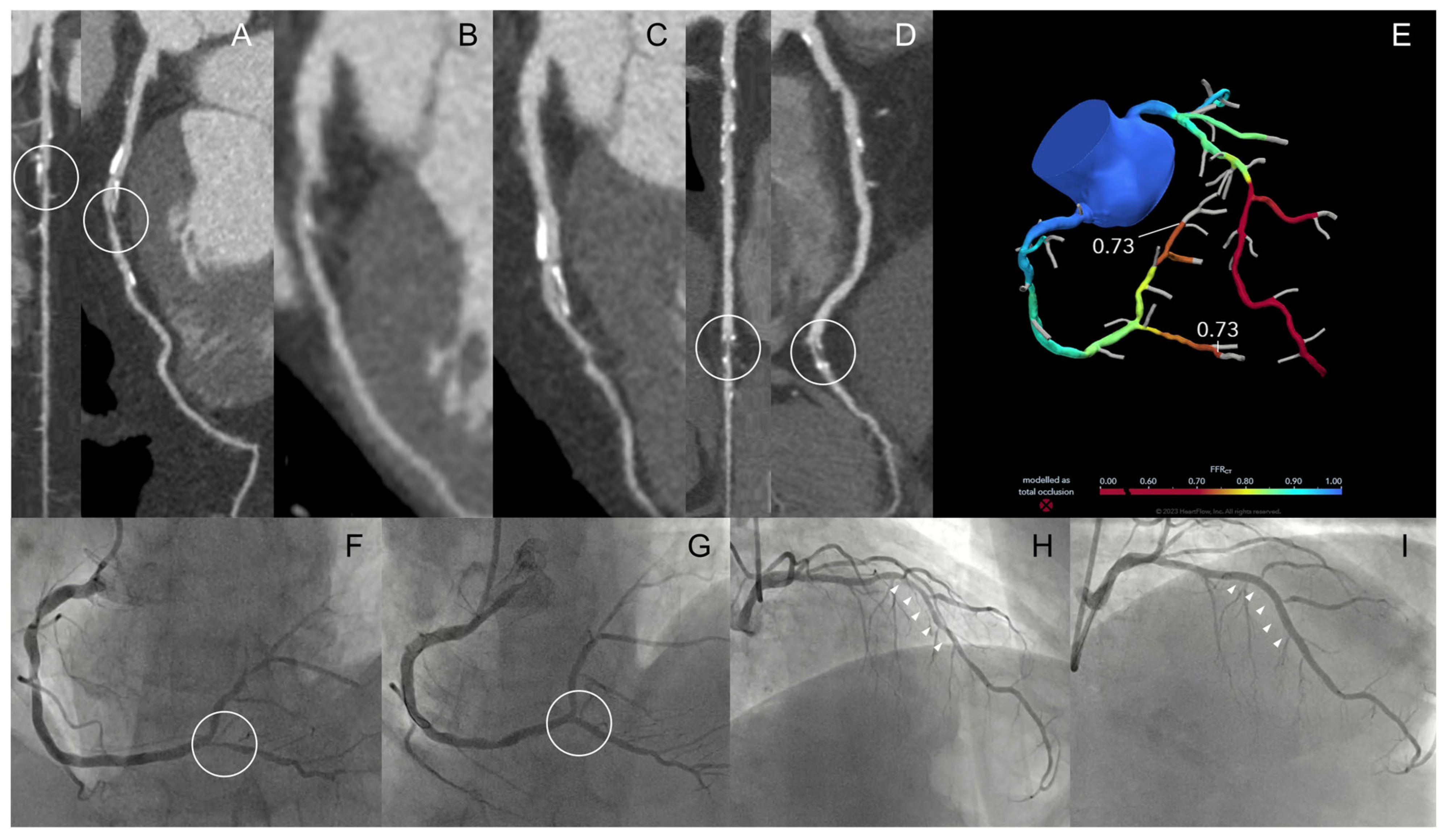 FFR-CT: Technical Advances and Implementation in Clinical Practice