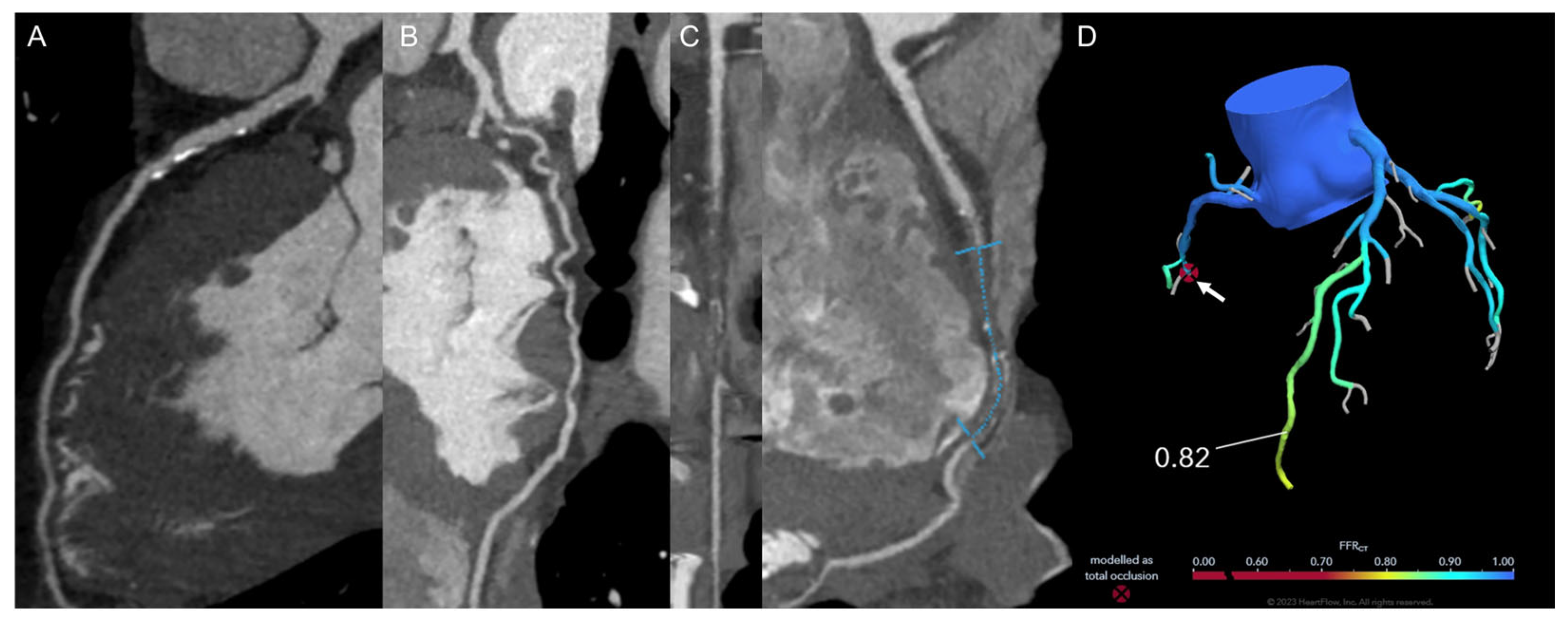 FFR-CT: Technical Advances and Implementation in Clinical Practice