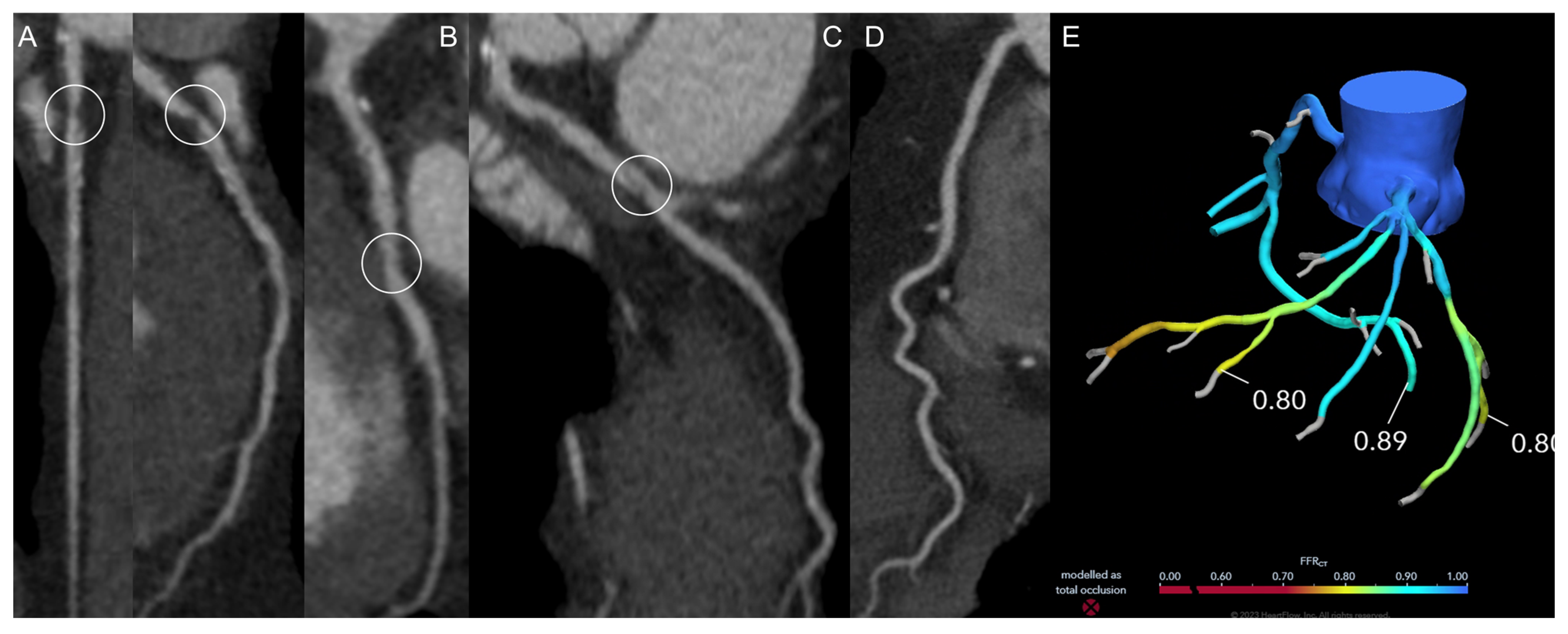 FFR-CT: Technical Advances and Implementation in Clinical Practice