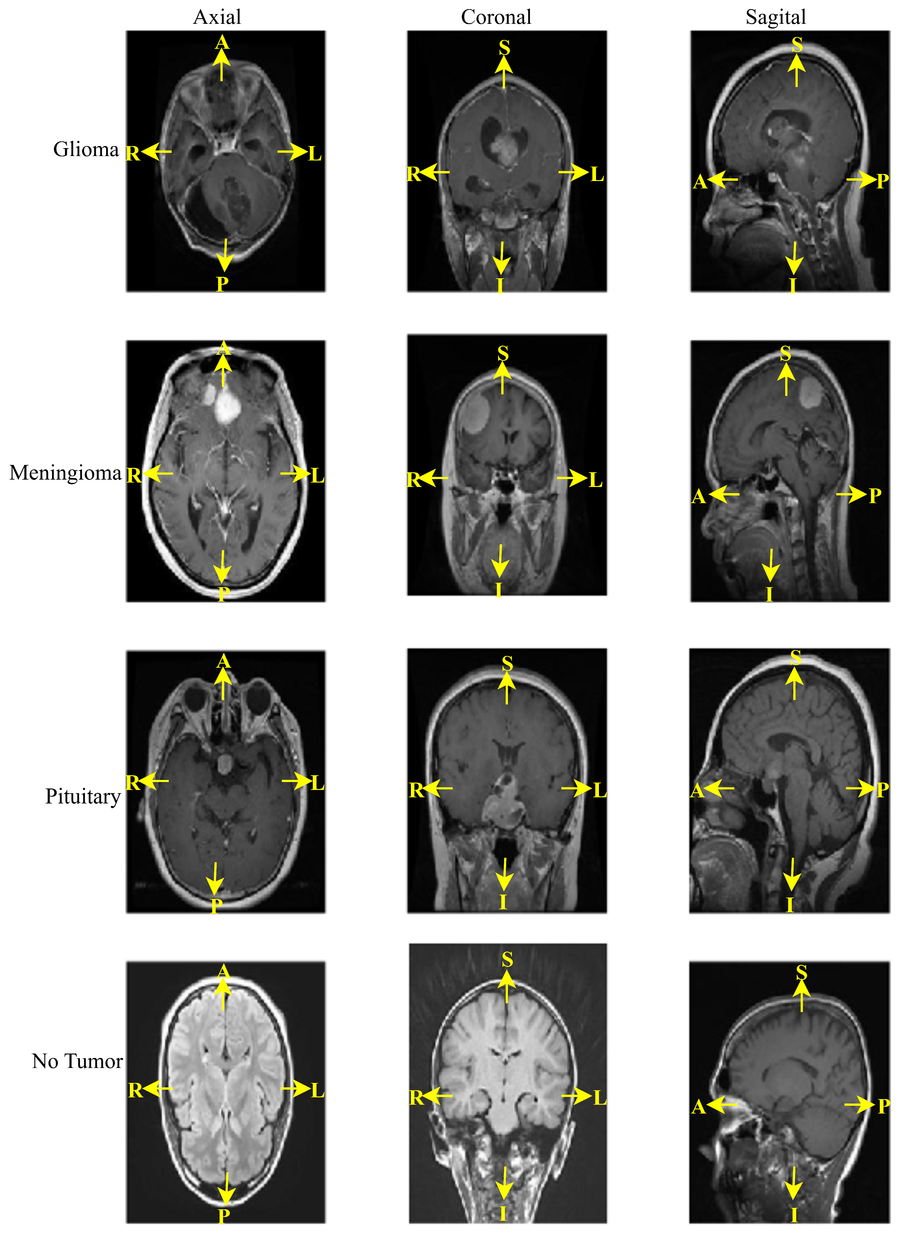 Brain Tumor Classification in MRI Images Using Combined Transfer ...