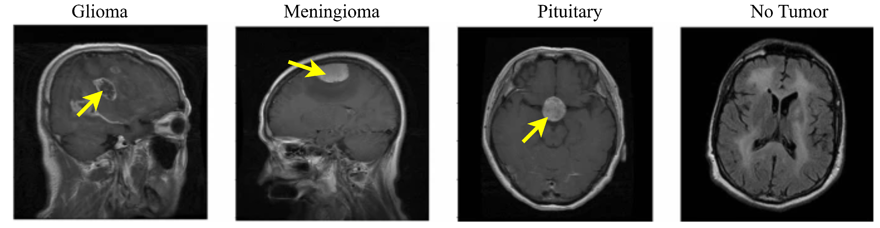Brain Tumor Classification in MRI Images Using Combined Transfer ...