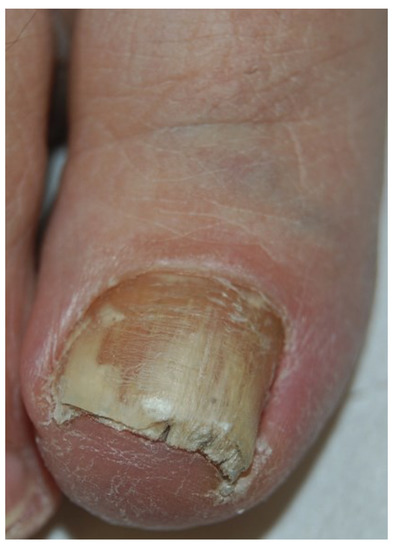 Fungal Infection Nail Fungus Candida On Stock Photo 2322973705 |  Shutterstock