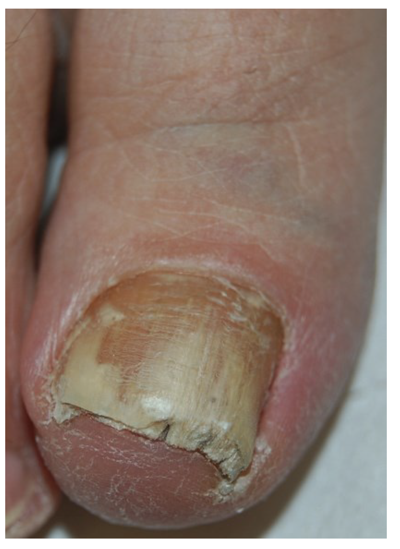 JoF | Free Full-Text | Onychomycosis: A Review