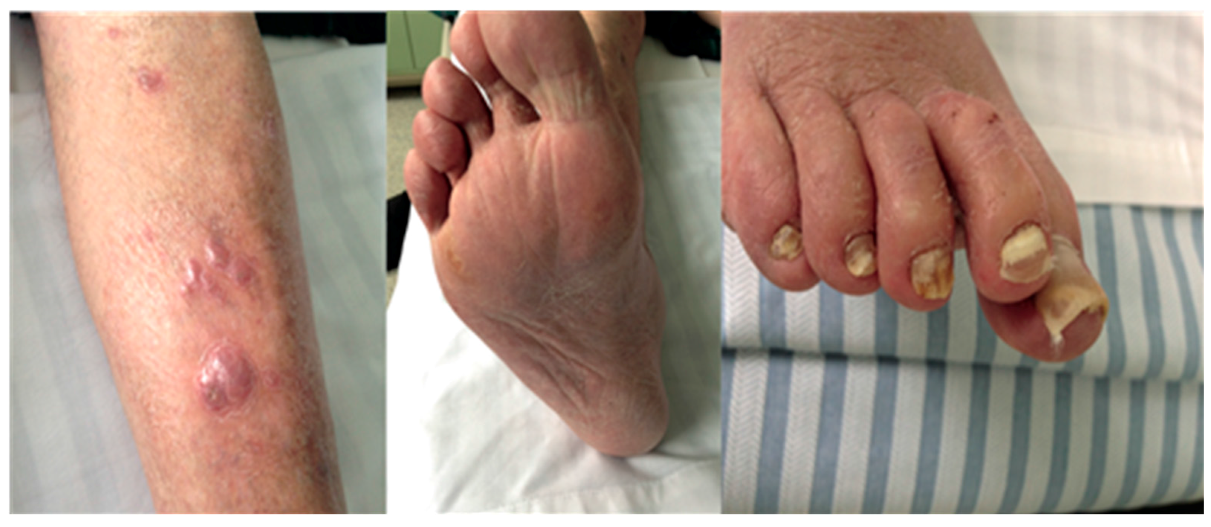 Tinea pedis and Tinea unguium caused by Trichophyton rubrum in an