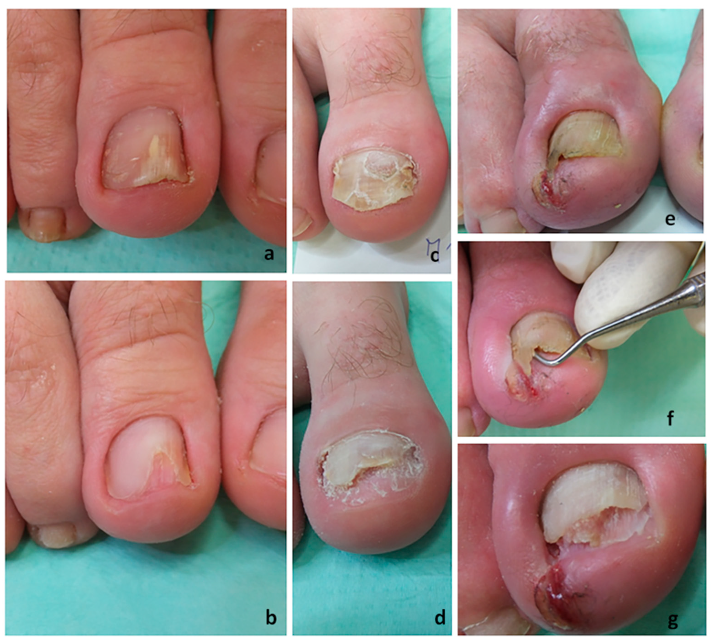 Effective Fungal Nail Treatment for a 16 year old patient