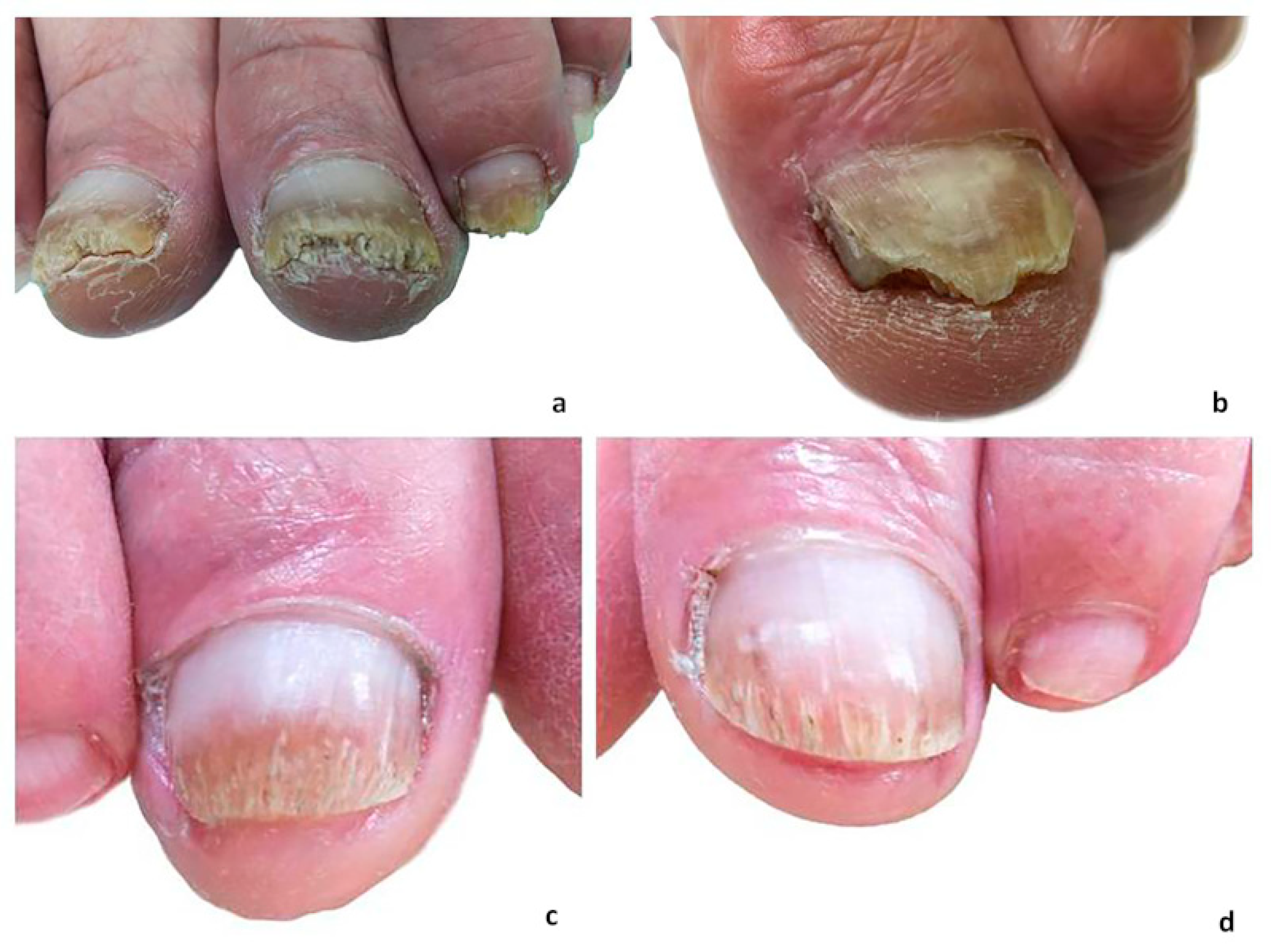 Onychomycosis: A Review of New and Emerging Topical and Device-based  Treatments | JCAD | The Journal of Clinical and Aesthetic Dermatology