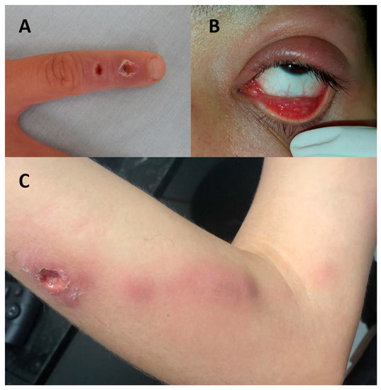 Staph infection vs. MRSA: Differences, symptoms, treatment