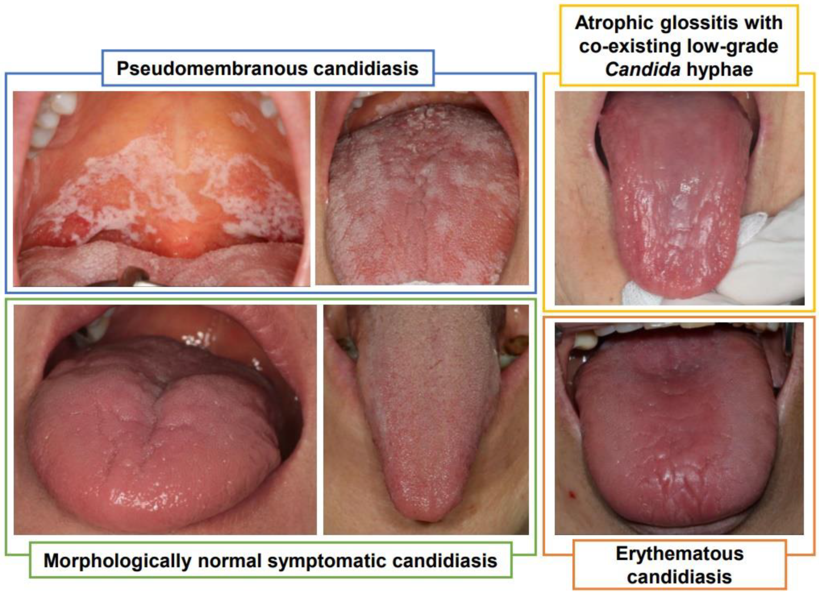 mild oral candidiasis