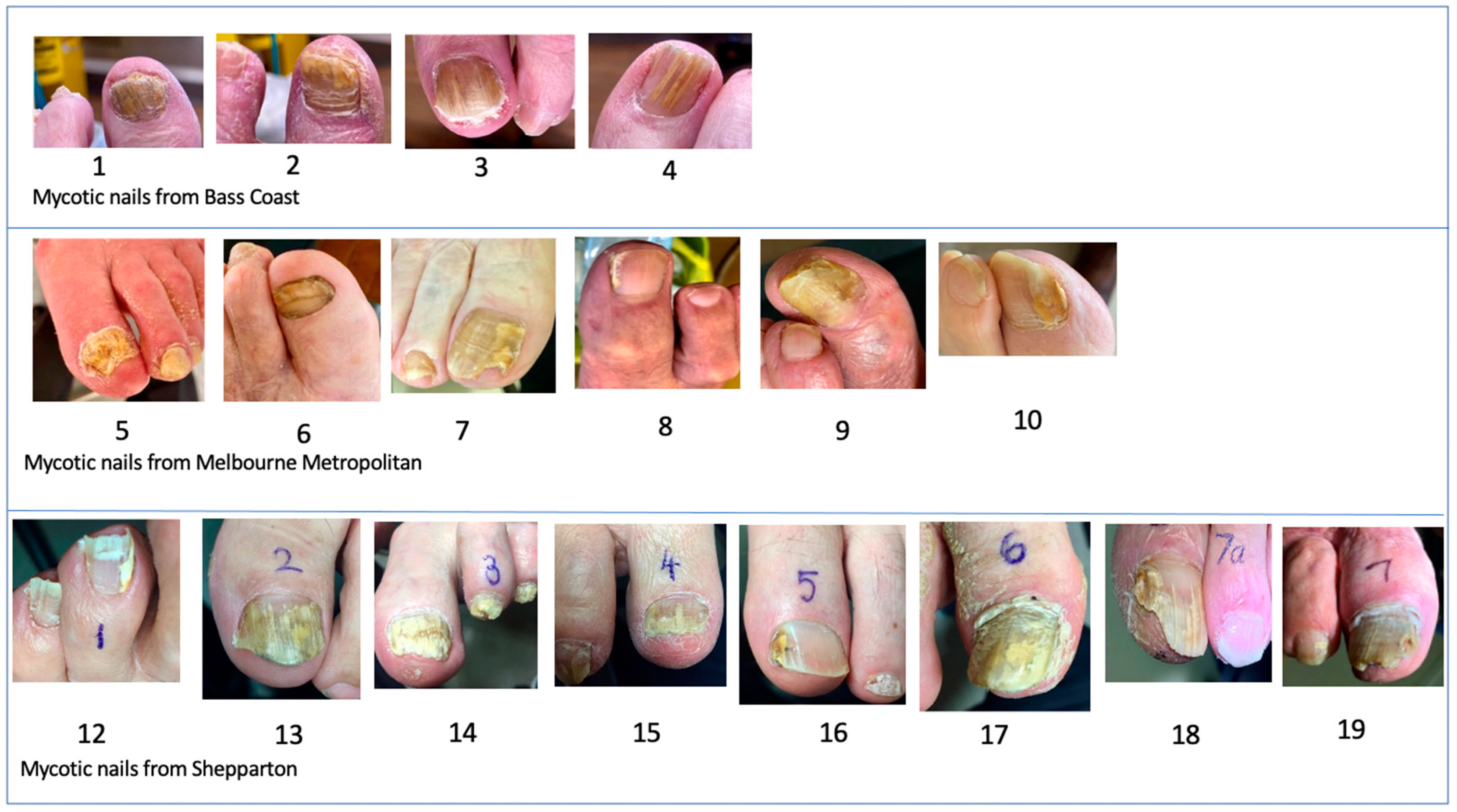 Nail Infections Caused By Fungi Such As: Onychomycosis Also Known As Tinea  Unguium. Caused By Dermatophytes And Yeasts And For The Concomitant  Antibacterial Activity Stock Photo, Picture and Royalty Free Image. Image