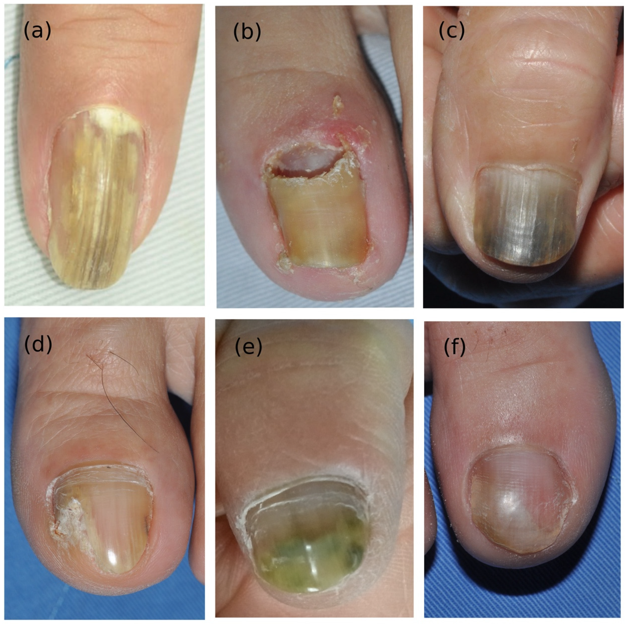 Can Fungal Nail Infection Spread | Apotheco