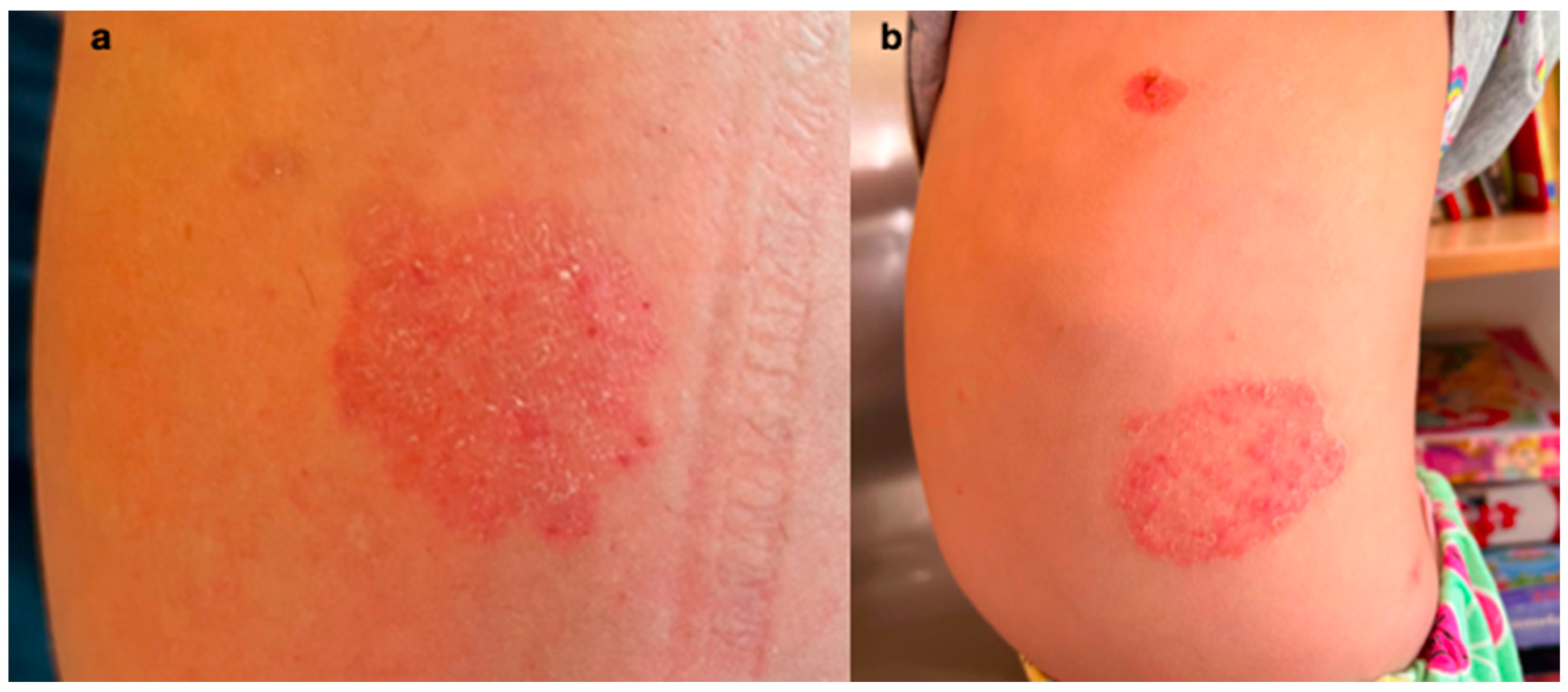 Dermoscopy and Ultraviolet-Enhanced Fluorescence Dermoscopy (UEFD ...