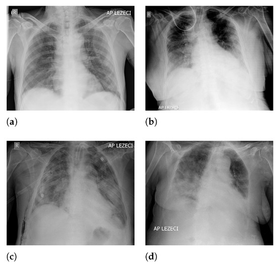 JPM | Free Full-Text | Automatic Evaluation of the Lung Condition of ...